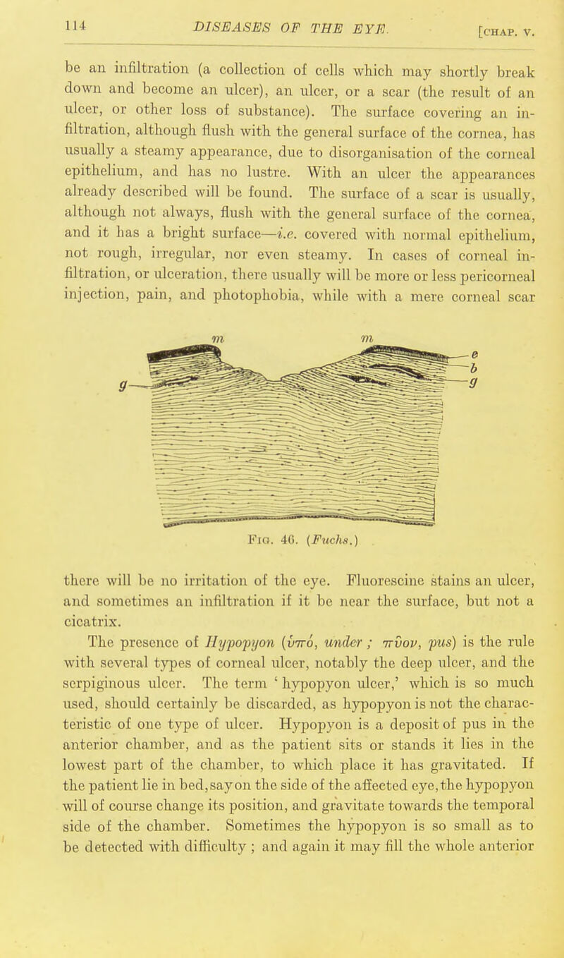 be an infiltration (a collection of cells which may shortly break down and become an ulcer), an ulcer, or a scar (the result of an ulcer, or other loss of substance). The surface covering an in- filtration, although flush with the general surface of the cornea, has usually a steamy appearance, due to disorganisation of the corneal epithelium, and has no lustre. With an ulcer the appearances already described will be found. The surface of a scar is usually, although not always, flush with the general surface of the cornea, and it has a bright surface—i.e. covered with normal epithelium, not rough, irregular, nor even steamy. In cases of corneal in- filtration, or ulceration, there usually will be more or less pericorneal injection, pain, and photophobia, while with a mere corneal scar Fio. 40. (Fucks.) there will be no irritation of the eye. Fluorescine stains an ulcer, and sometimes an infiltration if it be near the surface, but not a cicatrix. The presence of Hypopyon (vtto, under; ttvov, pus) is the rule with several types of corneal ulcer, notably the deep ulcer, and the serpiginous ulcer. The term ' hypopyon ulcer,' which is so much used, should certainly be discarded, as hypopyon is not the charac- teristic of one type of ulcer. Hypopyon is a deposit of pus in the anterior chamber, and as the patient sits or stands it lies in the lowest part of the chamber, to which place it has gravitated. If the patient lie in bed,sayon the side of the affected eye,the hypopyon will of course change its position, and gravitate towards the temporal side of the chamber. Sometimes the hypopyon is so small as to be detected with difficulty ; and again it may fill the whole anterior