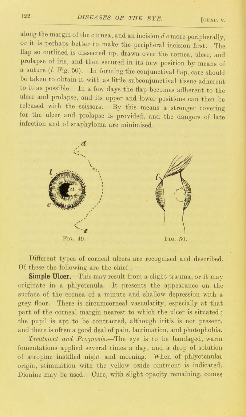 along the margin of the cornea, and an incision d e more peripherally, or it is perhaps better to make the peripheral incision first. The flap so outlined is dissected up, drawn over the cornea, ulcer, and prolapse of iris, and then secured in its new position by means of a suture (/, Fig. 50). In forming the conjunctival flap, care should be taken to obtain it with as little subconjunctival tissue adherent to it as possible. In a few days the flap becomes adherent to the ulcer and prolapse, and its upper and lower positions can then be released with the scissors. By this means a stronger covering for the ulcer and prolapse is provided, and the dangers of late infection and of staphyloma are minimised. Fid. 49. Fig. 50. Different types of corneal ulcers are recognised and described. Of these the following are the chief :— Simple Ulcer.—This may result from a slight trauma, or it may originate in a phlyctcnula. It presents the appearance on the surface of the cornea of a minute and shallow depression with a grey floor. There is circumcorneal vascularity, especially at that part of the corneal margin nearest to which the ulcer is situated ; the pupil is apt to be contracted, although iritis is not present, and there is often a good deal of pain, lacrimation, and photophobia. Treatment and Prognosis.—The eye is to be bandaged, warm fomentations applied several times a day, and a drop of solution of atropine instilled night and morning. When of phlyctenular origin, stimulation with the yellow oxide ointment is indicated. Dionine may be used, Cure, with slight opacity remaining, comes