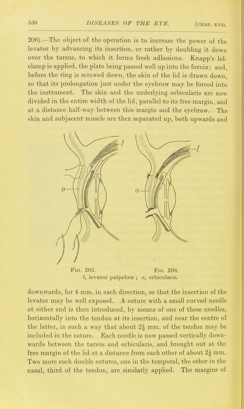 206).—The object of the operation is to increase the power of the levator by advancing its insertion, or rather by doubling it down over the tarsus, to which it forms fresh adhesions. Knapp's lid- clarnp is applied, the plate being passed well up into the fornix; and, before the ring is screwed down, the skin of the lid is drawn down, so that its prolongation just under the eyebrow may be forced into the instrument. The skin and the underlying orbicularis are now divided in the entire width of the lid, parallel to its free margin, and at a distance half-way between this margin and the eyebrow. The skin and subjacent muscle are then separated up, both upwards and Fig. 205. FiO. 20(5. I, levator palpebrae ; o, orbicularis. downwards, for 4 mm. in each direction, so that the insertion of the levator may be well exposed. A suture with a small curved needle at either end is then introduced, by means of one of these needles, horizontally into the tendon at its insertion, and near the centre of the latter, in such a way that about 2| mm. of the tendon may be included in the suture. Each needle is now passed vertically down- wards between the tarsus and orbicularis, and brought out at the free margin of the lid at a distance from each other of about 2| mm. Two more such double sutures, one in the temporal, the other in the nasal, third of the tendon, are similarly applied. The margins of