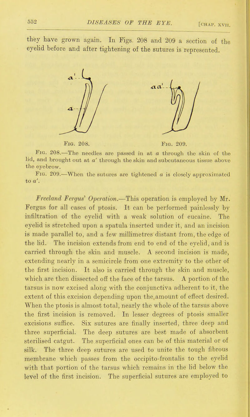 they have grown again. In Figs. 208 and 209 a section of the eyelid before and after tightening of the sutures is represented. Fig. 208. Fia. 209. Fig. 208.—The needles nre passed in at a through tho skin of the lid, and brought out at a' through the skin and subcutaneous tissue above the eyebrow. Fig. 20!).—When the sutures are tightened a is closely approximated to a'. Wretikmd Fen/us' Operation.—This operation is employed by Mr. Fergus for all cases of ptosis. It can be performed painlessly by infiltration of the eyelid with a weak solution of eucaine. The eyelid is stretched upon a spatula inserted under it, and an incision is made parallel to, and a lew millimetres distant from, the edge of the lid. The incision extends from end to end of the eyelid, and is carried through the skin and muscle. A second incision is made, extending nearly in a semicircle from one extremity to the other of the first incision. It also is carried through the skin and muscle, which are then dissected off the face of the tarsus. A portion of the tarsus is now excised along with the conjunctiva adherent to it, the extent of this excision depending upon the amount of effect desired. When the ptosis is almost total, nearly the whole of the tarsus above the first incision is removed. In lesser degrees of ptosis smaller excisions suffice. Six sutures are finally inserted, three deep and three superficial. The deep sutures are best made of absorbent sterilised catgut. The superficial ones can be of this material or of silk. The three deep sutures are used to unite the tough fibrous membrane which passes from the occipito-frontalis to the eyelid with that portion of the tarsus which remains in the lid below the. level of the first incision. The superficial sutures are employed to