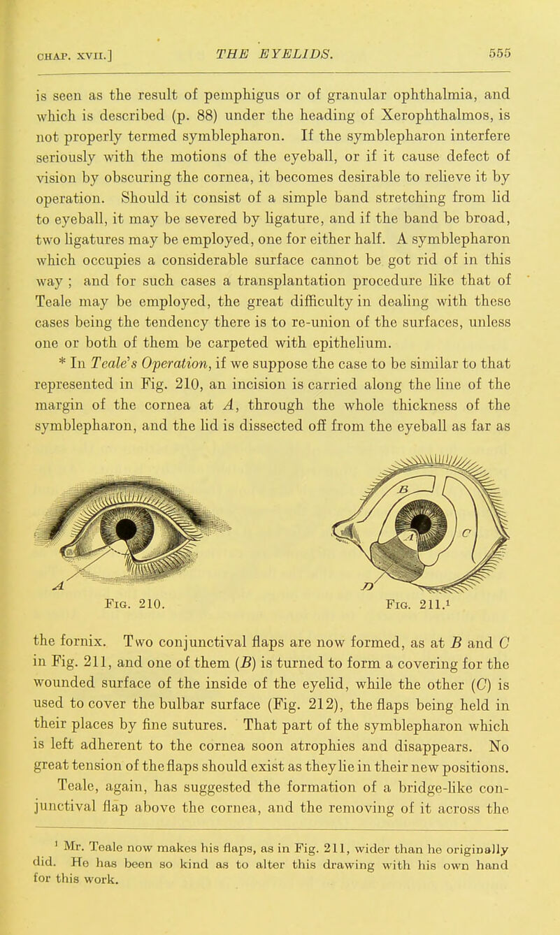 is seen as the result of pemphigus or of granular ophthalmia, and which is described (p. 88) under the heading of Xerophthalmos, is not properly termed symblepharon. If the symblepharon interfere seriously with the motions of the eyeball, or if it cause defect of vision by obscuring the cornea, it becomes desirable to relieve it by operation. Should it consist of a simple band stretching from lid to eyeball, it may be severed by ligature, and if the band be broad, two ligatures may be employed, one for either half. A symblepharon which occupies a considerable surface cannot be got rid of in this way ; and for such cases a transplantation procedure like that of Teale may be employed, the great difficulty in dealing with these cases being the tendency there is to re-union of the surfaces, unless one or both of them be carpeted with epithelium. * In Teale's Operation, if we suppose the case to be similar to that represented in Fig. 210, an incision is carried along the hue of the margin of the cornea at A, through the whole thickness of the symblepharon, and the lid is dissected off from the eyeball as far as Fig. 210. Fig. 211.1 the fornix. Two conjunctival flaps are now formed, as at B and G in Fig. 211, and one of them (B) is turned to form a covering for the wounded surface of the inside of the eyelid, while the other (C) is used to cover the bulbar surface (Fig. 212), the flaps being held in their places by fine sutures. That part of the symblepharon which is left adherent to the cornea soon atrophies and disappears. No great tension of the flaps should exist as they he in their new positions. Teale, again, has suggested the formation of a bridge-like con- junctival flap above the cornea, and the removing of it across the 1 Mr. Toale now makes his flaps, as in Fig. 211, wider than he originally • lid. He has been so kind as to alter this drawing with his own hand for this work.
