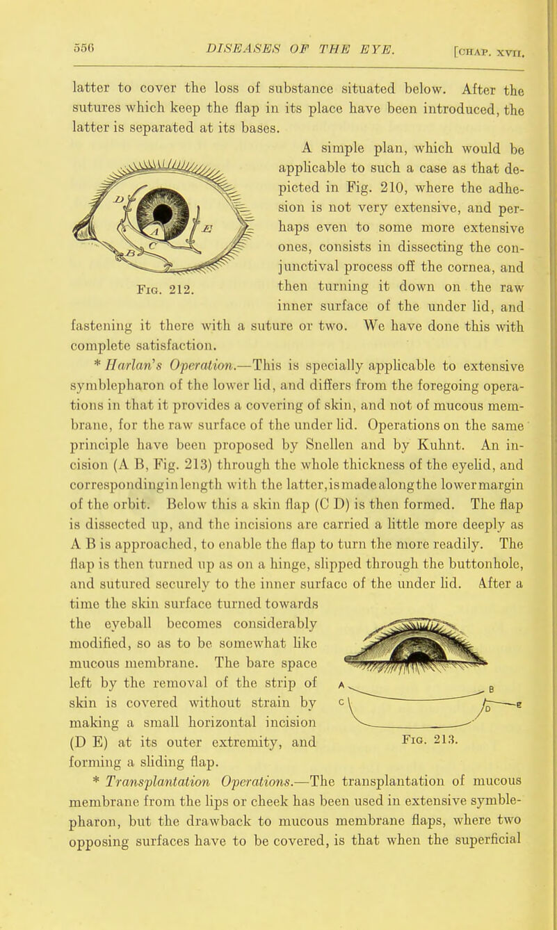 Fig. 212. latter to cover the loss of substance situated below. After the sutures which keep the flap in its place have been introduced, the latter is separated at its bases. A simple plan, which would be applicable to such a case as that de- picted in Fig. 210, where the adhe- sion is not very extensive, and per- haps even to some more extensive ones, consists in dissecting the con- junctival process off the cornea, and then turning it down on the raw inner surface of the under lid, and fastening it there with a suture or two. We have done this with complete satisfaction. * Harlan's Operation.—This is specially applicable to extensive symblepharon of the lower lid, and differs from the foregoing opera- tions in that it provides a covering of skin, and not of mucous mem- brane, for the raw surface of the under lid. Operations on the same principle have been proposed by Snellen and by Kuhnt. An in- cision (A B, Fig. 213) through the whole thickness of the eyebd, and corresponding in length with the latter,is madealongthe lower margin of the orbit Below this a skin flap (C D) is then formed. The flap is dissected up, and the incisions are carried a little more deeply as A B is approached, to enable the flap to turn the more readily. The flap is then turned up as on a hinge, slipped through the buttonhole, and sutured securely to the inner surface of the under lid. After a time the skin surface turned towards the eyeball becomes considerably modified, so as to be somewhat like mucous membrane. The bare space left by the removal of the strip of skin is covered without strain by making a small horizontal incision (D E) at its outer extremity, and forming a sliding flap. * Transplantation Operations.—The transplantation of mucous membrane from the lips or cheek has been used in extensive symble- pharon, but the drawback to mucous membrane flaps, where two opposing surfaces have to be covered, is that when the superficial