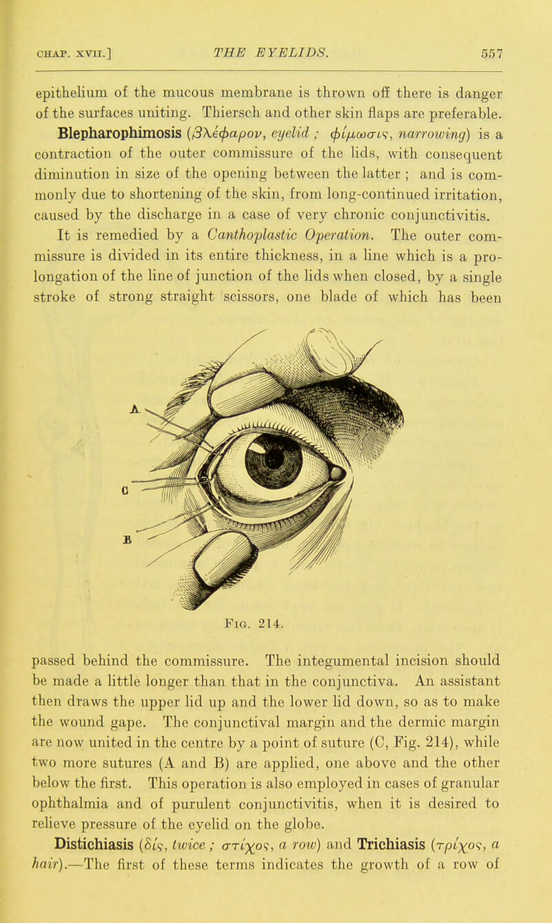 epithelium of the mucous membrane is thrown off there is danger of the surfaces uniting. Thiersch and other skin flaps are preferable. Blepharophimosis ($\e(f)apov, eyelid ; (fiLficoait, narrowing) is a contraction of the outer commissure of the lids, with consequent diminution in size of the opening between the latter ; and is com- monly due to shortening of the skin, from long-continued irritation, caused by the discharge in a case of very chronic conjunctivitis. It is remedied by a Canthoplastic Operation. The outer com- missure is divided in its entire thickness, in a line which is a pro- longation of the line of junction of the lids when closed, by a single stroke of strong straight scissors, one blade of which has been Fig. 214. passed behind the commissure. The integumental incision should be made a little longer than that in the conjunctiva. An assistant then draws the upper lid up and the lower lid down, so as to make the wound gape. The conjunctival margin and the dermic margin are now united in the centre by a point of suture (C, Pig. 214), while two more sutures (A and B) are applied, one above and the other below the first. This operation is also employed in cases of granular ophthalmia and of purulent conjunctivitis, when it is desired to relieve pressure of the eyelid on the globe. Distichiasis (Sis, twice; crrt^ov, a row) and Trichiasis (r/at^o?, a hair).—The first of these terms indicates the growth of a row of