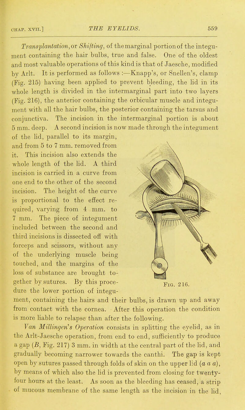Transplantation, ov Shifting, of the marginal portion of the integu- ment containing the hair bulbs, true and false. One of the oldest and most valuable operations of this kind is that of Jaesche, modified by Arlt. It is performed as follows :—Knapp's, or Snellen's, clamp (Fig. 215) having been apphed to prevent bleeding, the lid in its whole length is divided in the intermarginal part into two layers (Fig. 216), the anterior containing the orbicular muscle and integu- ment with all the hair bulbs, the posterior containing the tarsus and conjunctiva. The incision in the intermarginal portion is about 5 mm. deep. A second incision is now made through the integument of the lid, parallel to its margin, and from 5 to 7 mm. removed from it. This incision also extends the whole length of the lid. A third incision is carried in a curve from one end to the other of the second incision. The height of the curve is proportional to the effect re- quired, varying from 4 mm. to 7 mm. The piece of integument included between the second and third incisions is dissected off with forceps and scissors, without any of the underlying muscle being touched, and the margins of the loss of substance are brought to- gether by sutures. By this proce- dure the lower portion of integu- ment, containing the hairs and their bulbs, is drawn up and away from contact with the cornea. After this operation the condition is more liable to relapse than after the following. Van Millingeri's Operation consists in splitting the eyelid, as in the Arlt-Jaesche operation, from end to end, sufficiently to produce a gap (B, Fig. 217) 3 mm. in width at the central part of the lid, and gradually becoming narrower towards the canthi. The gap is kept open by sutures passed through folds of skin on the upper lid (a a a), by means of which also the lid is prevented from closing for twenty- four hours at the least. As soon as the bleeding has ceased, a strip ot mucous membrane of the same length as the incision in the lid,