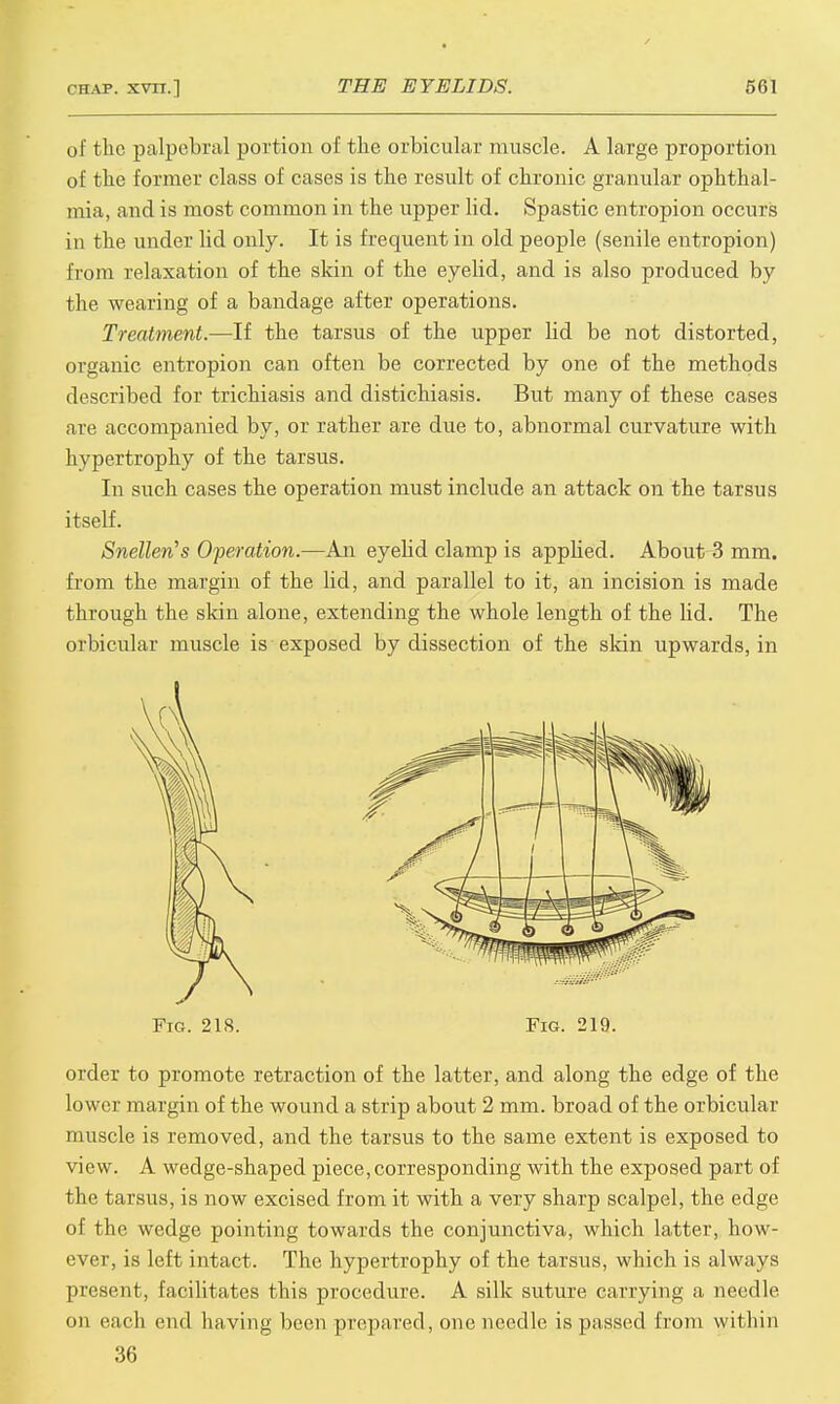of the palpebral portion of the orbicular muscle. A large proportion of the former class of cases is the result of chronic granular ophthal- mia, and is most common in the upper lid. Spastic entropion occurs in the under lid only. It is frequent in old people (senile entropion) from relaxation of the skin of the eyelid, and is also produced by the wearing of a bandage after operations. Treatment.—If the tarsus of the upper lid be not distorted, organic entropion can often be corrected by one of the methods described for trichiasis and distichiasis. But many of these cases are accompanied by, or rather are due to, abnormal curvature with hypertrophy of the tarsus. In such cases the operation must include an attack on the tarsus itself. Snellen's Operation.—An eyelid clamp is applied. About 3 mm. from the margin of the lid, and parallel to it, an incision is made through the skin alone, extending the whole length of the lid. The orbicular muscle is exposed by dissection of the skin upwards, in Fig. 2IS. Fig. 219. order to promote retraction of the latter, and along the edge of the lower margin of the wound a strip about 2 mm. broad of the orbicular muscle is removed, and the tarsus to the same extent is exposed to view. A wedge-shaped piece,corresponding with the exposed part of the tarsus, is now excised from it with a very sharp scalpel, the edge of the wedge pointing towards the conjunctiva, which latter, how- ever, is left intact. The hypertrophy of the tarsus, which is always present, facilitates this procedure. A silk suture carrying a needle orj each end having been prepared, one needle is passed from within 36