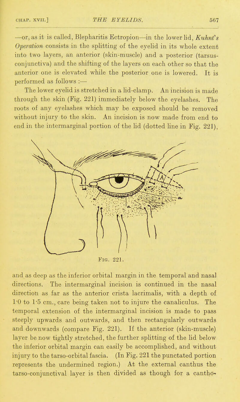 —or, as it is called, Blepharitis Ectropion—in the lower lid, KuhnCs Operation consists in the splitting of the eyelid in its whole extent into two layers, an anterior (skin-muscle) and a posterior (tarsus- conjunctiva) and the shifting of the layers on each other so that the anterior one is elevated while the posterior one is lowered. It is performed as follows :— The lower eyelid is stretched in a lid-clamp. An incision is made through the skin (Fig. 221) immediately below the eyelashes. The roots of any eyelashes which may be exposed should be removed without injury to the skin. An incision is now made from end to end in the intermarginal portion of the lid (dotted line in Fig. 221), and as deep as the inferior orbital margin in the temporal and nasal directions. The intermarginal incision is continued in the nasal direction as far as the anterior crista lacrimalis, with a depth of TO to 15 cm., care being taken not to injure the canaliculus. The temporal extension of the intermarginal incision is made to pass steeply upwards and outwards, and then rectangularly outwards and downwards (compare Fig. 221). If the anterior (skin-muscle) layer be now tightly stretched, the further splitting of the lid below the inferior orbital margin can easily be accomplished, and without injury to the tarso-orbital fascia. (In Fig. 221 the punctated portion represents the undermined region.) At the external canthus the tarso-conjunctival layer is then divided as though for a canthoi-
