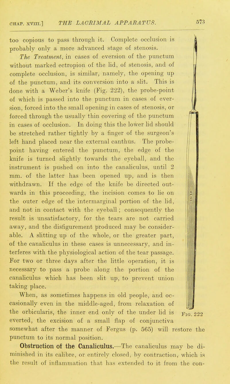 too copious to pass through it. Complete occlusion is probably only a more advanced stage of stenosis. The Treatment, in cases of eversion of the punctum without marked ectropion of the lid, of stenosis, and of complete occlusion, is similar, namely, the opening up of the punctum, and its conversion into a slit. This is done with a Weber's knife (Fig. 222), the probe-point of which is passed into the punctum in cases of ever- sion, forced into the small opening in cases of stenosis, or forced through the usually thin covering of the punctum in cases of occlusion. In doing this the lower lid should be stretched rather tightly by a finger of the surgeon's left hand placed near the external canthus. The probe- point having entered the punctum, the edge of the knife is turned slightly towards the eyeball, and the instrument is pushed on into the canaliculus, until 2 mm. of the latter has been opened up, and is then withdrawn. If the edge of the knife be directed out- wards in this proceeding, the incision comes to he on the outer edge of the intermarginal portion of the hd, and not in contact with the eyeball; consequently the result is unsatisfactory, for the tears are not carried away, and the disfigurement produced may be consider- able. A slitting up of the whole, or the greater part, of the canahculus in these cases is unnecessary, and in- terferes with the physiological action of the tear passage. For two or three days after the little operation, it is necessary to pass a probe along the portion of the canaliculus which has been slit up, to prevent union taking place. When, as sometimes happens in old people, and oc- casionallv even in the middle-aged, from relaxation of m the orbicularis, the inner end only of the under lid is j?JQ 222 everted, the excision of a small flap of conjunctiva somewhat after the manner of Fergus (p. 565) will restore the punctum to its normal position. Obstruction of the Canaliculus.—The canaliculus may be di- minished in its calibre, or entirely closed, by contraction, which is tlif result of inflammation that has extended to it from the con-