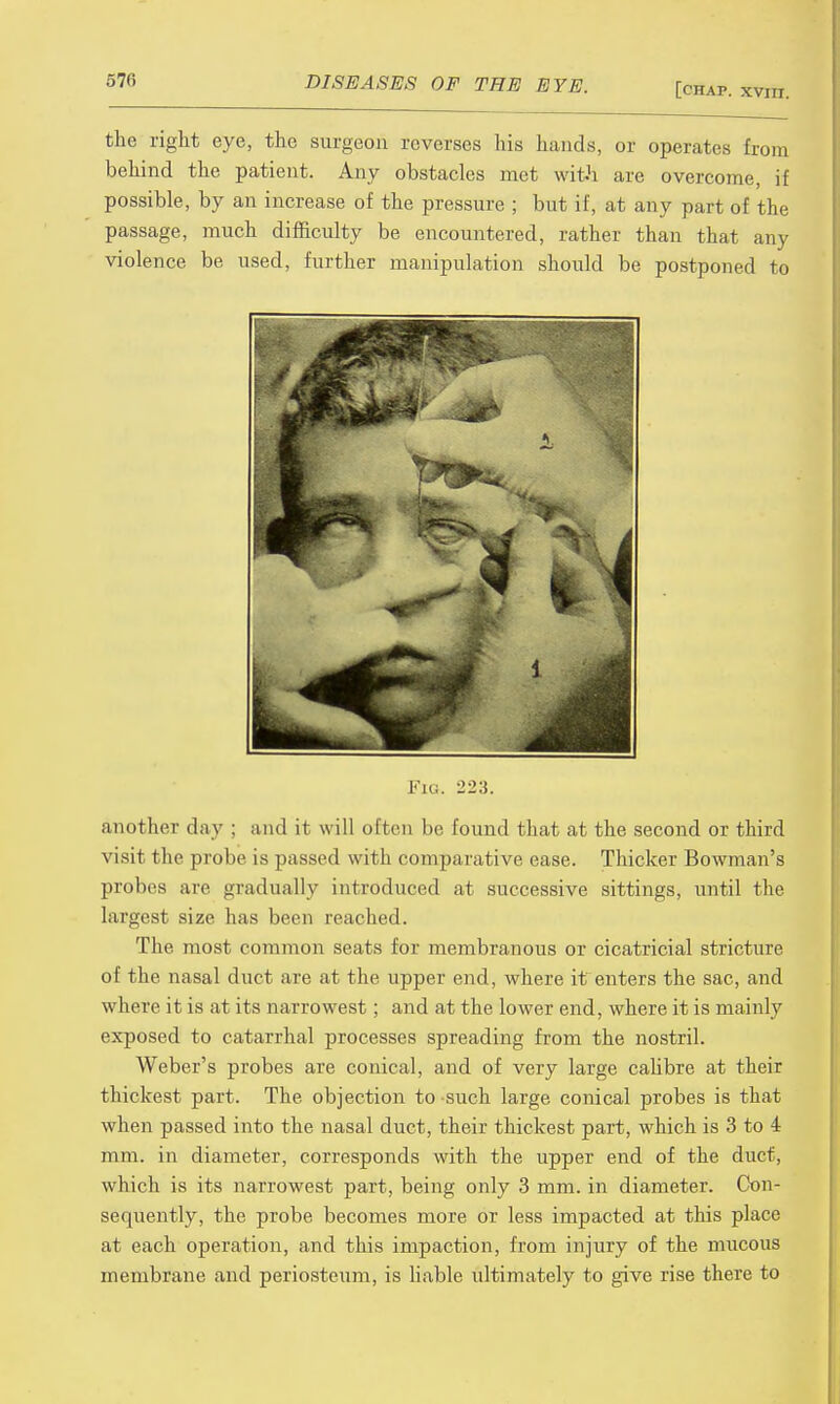 [chap, xviii. the right eye, the surgeon reverses his hands, or operates from behind the patient. Any obstacles met with are overcome, if possible, by an increase of the pressure ; but if, at any part of the passage, much difficulty be encountered, rather than that any violence be used, further manipulation should be postponed to Fio. 223. another day : and it will often be found that at the second or third visit the probe is passed with comparative ease. Thicker Bowman's probes are gradually introduced at successive sittings, until the largest size has been reached. The most common seats for membranous or cicatricial stricture of the nasal duct are at the upper end, where it enters the sac, and where it is at its narrowest; and at the lower end, where it is mainly exposed to catarrhal processes spreading from the nostril. Weber's probes are conical, and of very large calibre at their thickest part. The objection to such large conical probes is that when passed into the nasal duct, their thickest part, which is 3 to 4 mm. in diameter, corresponds with the upper end of the duct, which is its narrowest part, being only 3 mm. in diameter. Con- sequently, the probe becomes more or less impacted at this place at each operation, and this impaction, from injury of the mucous membrane and periosteum, is liable ultimately to give rise there to