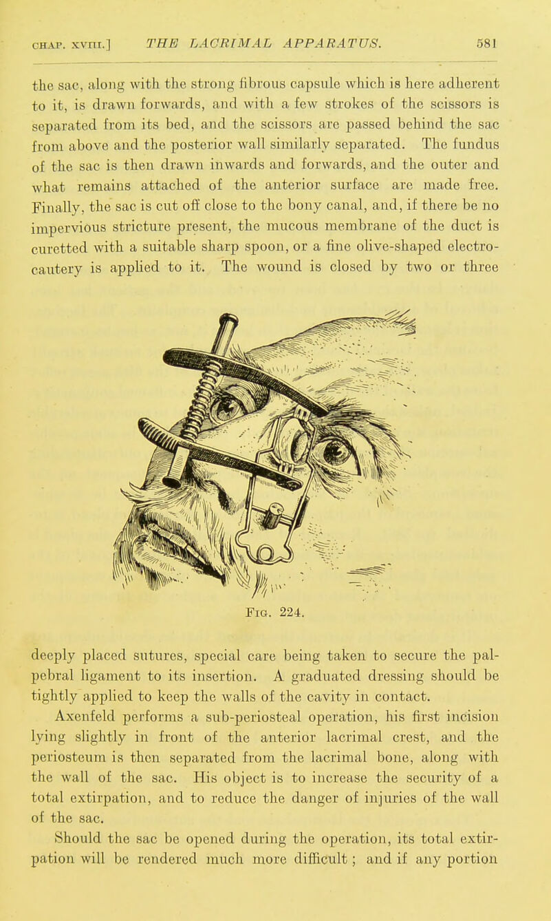 the sac, along with the strong fibrous capsule which is here adherent to it, is drawn forwards, and with a few strokes of the scissors is separated from its bed, and the scissors are passed behind the sac from above and the posterior wall similarly separated. The fundus of the sac is then drawn inwards and forwards, and the outer and what remains attached of the anterior surface are made free. Finally, the sac is cut off close to the bony canal, and, if there be no impervious stricture present, the mucous membrane of the duct is curetted with a suitable sharp spoon, or a fine olive-shaped electro- cautery is applied to it. The wound is closed by two or three Fig. 224. deeply placed sutures, special care being taken to secure the pal- pebral ligament to its insertion. A graduated dressing should be tightly applied to keep the walls of the cavity in contact. Axenfeld performs a sub-periosteal operation, his first incision lying slightly in front of the anterior lacrimal crest, and the periosteum is then separated from the lacrimal bone, along with the wall of the sac. His object is to increase the security of a total extirpation, and to reduce the danger of injuries of the wall of the sac. ■Should the sac be opened during the operation, its total extir- pation will be rendered much more difficult; and if any portion