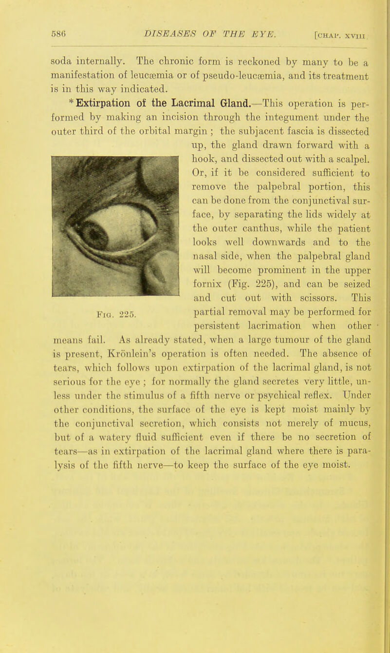 soda internally. The chronic form is reckoned by many to be a manifestation of leucaemia or of pseudo-leucaemia, and its treatment is in this way indicated. * Extirpation of the Lacrimal Gland.—This operation is per- formed by making an incision through the. integument under the outer third of the orbital margin ; the subjacent fascia is dissected means fail. As already staled, when a large tumour of the gland is present, Kronlein's operation is often needed. The absence of tears, which follows upon extirpation of the lacrimal gland, is not serious for the eye ; lor normally the gland secretes very little, un- less under the stimulus of a fifth nerve or psychical reflex. Under other conditions, the surface of the eye is kept moist mainly by the conjunctival secretion, which consists not merely of mucus, but of a watery fluid sufficient even if there be no secretion of tears—as in extirpation of the lacrimal gland where there is para- lysis of the fifth nerve—to keep the surface of the eye moist. Fig. 225. up, the gland drawn forward with a hook, and dissected out with a scalpel. Or, if it be considered sufficient to remove the palpebral portion, this can be done from the conjunctival sur- face, by separating the lids widely at the outer canthus, while the patient looks well downwards and to the nasal side, when the palpebral gland will become prominent in the upper fornix (Fig. 225), and can be seized and cut out with scissors. This partial removal may be performed for persistent lacrimation when other