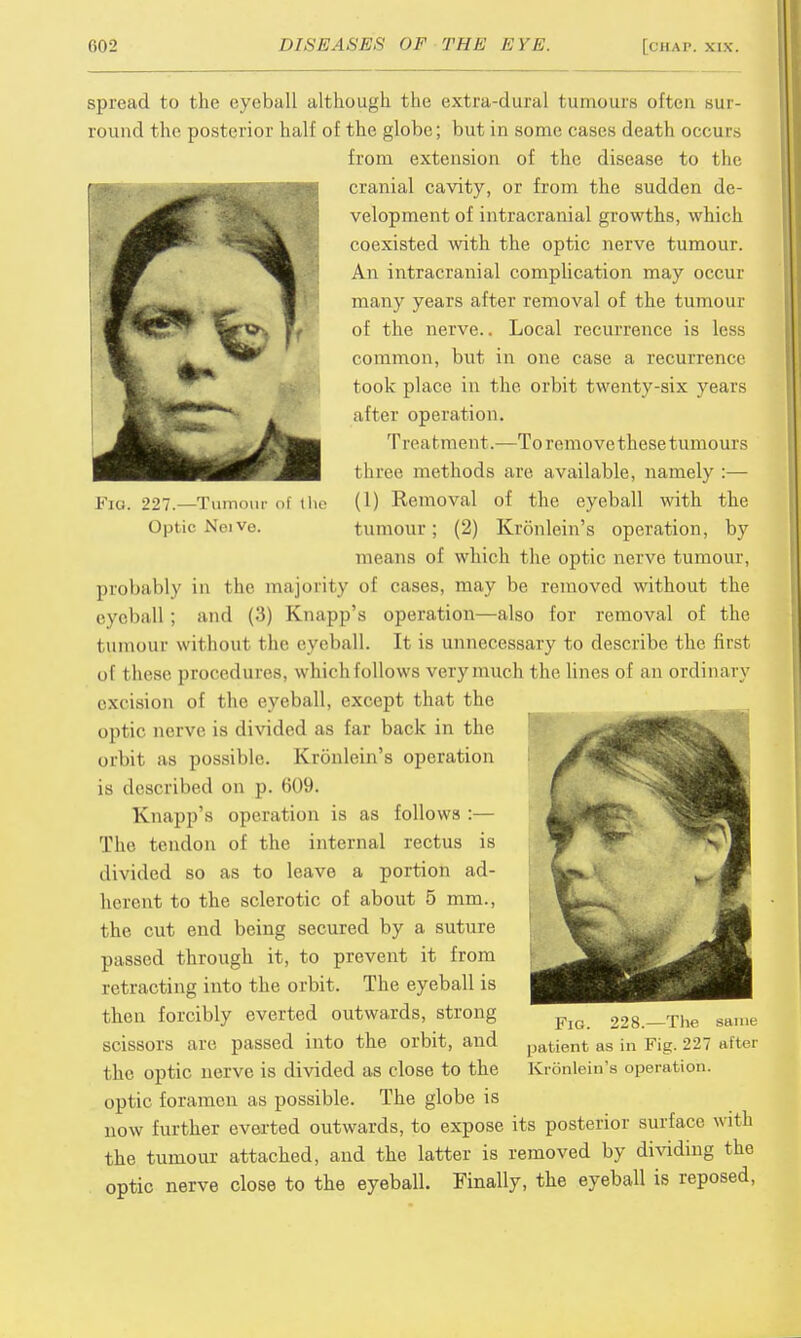 Fig. 227.—Tumour of the Optic NoiVe. spread to the eyeball although the extra-dural tumours often sur- round the posterior half of the globe; but in some cases death occurs from extension of the disease to the cranial cavity, or from the sudden de- velopment of intracranial growths, which coexisted with the optic nerve tumour. An intracranial complication may occur many years after removal of the tumour of the nerve.. Local recurrence is less common, but in one case a recurrence took place in the orbit twenty-six years after operation. Treatment.—To remove these tumours three methods are available, namely :— (1) Removal of the eyeball with the tumour; (2) Kronlein's operation, by means of which the optic nerve tumour, probably in the majority of cases, may be removed without the eyeball ; and (3) Knapp's operation—also for removal of the tumour without the eyeball. It is unnecessary to describe the first of t hese procedures, which follows very much the lines of an ordinary excision of the eyeball, except that the optic nerve is divided as far back in the orbit as possible. Kronlein's operation is described on p. 609. Knapp's operation is as follows :— The tendon of the internal rectus is divided so as to leave a portion ad- herent to the sclerotic of about 5 mm., the cut end being secured by a suture passed through it, to prevent it from retracting into the orbit. The eyeball is then forcibly everted outwards, strong scissors are passed into the orbit, and the optic nerve is divided as close to the optic foramen as possible. The globe is now further everted outwards, to expose its posterior surface with the tumour attached, and the latter is removed by dividing the optic nerve close to the eyeball. Finally, the eyeball is reposed, Fig. 228.—The same patient as in Fig. 227 after Kronlein's operation.