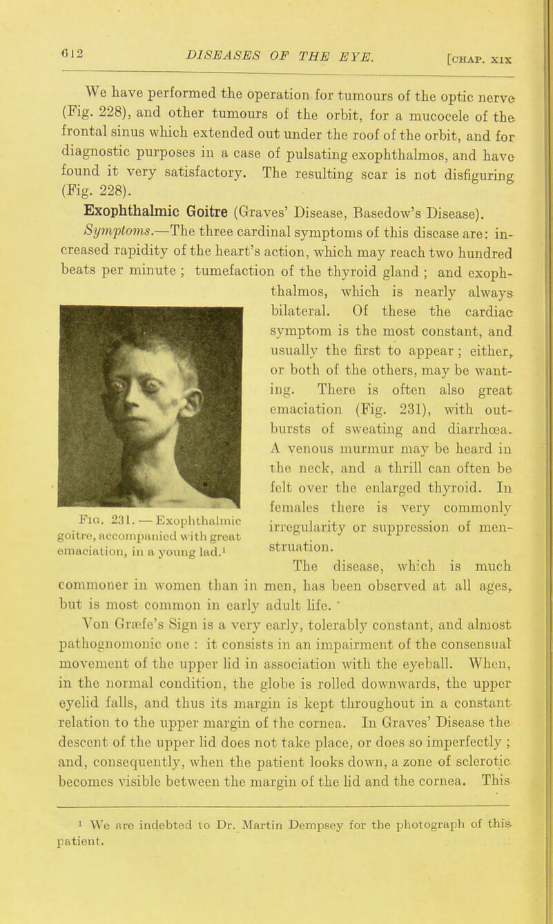 [chap, xix We have performed the operation for tumours of the optic nerve (Fig. 228), and other tumours of the orbit, for a mucocele of the frontal sinus which extended out under the roof of the orbit, and for diagnostic purposes in a case of pulsating exophthalmos, and have found it very satisfactory. The resulting scar is not disfiguring (Fig. 228). Exophthalmic Goitre (Graves' Disease, Basedow's Disease). Symptoms.—The three cardinal symptoms of this disease are: in- creased rapidity of the heart's action, which may reach two hundred beats per minute ; tumefaction of the thyroid gland ; and exoph- thalmos, which is nearly always bilateral. Of these the cardiac symptom is the most constant, and usually the first to appear ; either, or both of the others, may be want- ing. There is often also great emaciation (Fig. 231), with out- hursts of sweating and diarrhoea. A venous murmur may be heard in the neck, and a thrill can often be felt over the enlarged thyroid. In Eemales there is very commonly irregularity or suppression of men- st riiation. The disease, which is much commoner in women than in men, has been observed at all ages, but is most common in early adult life. * Von Grace's Sign is a very early, tolerably constant, and almost pathognomonic one : it consists in an impairment of the consensual movement of the upper lid in association with the eyeball. When, in the normal condition, the globe is rolled downwards, the upper eyelid falls, and thus its margin is kept throughout in a constant relation to the upper margin of the cornea. In Graves' Disease the descent of the upper lid does not take place, or does so imperfectly ; and, consequently, when the patient looks down, a zone of sclerotic becomes visible between the margin of the lid and the cornea. This Fig. 231.—Exophthalmic goitre, accompanied with groat emaciation, in a young lad.1 1 We are indebted to Dr. Martin Dempsey for the photograph of this patient.