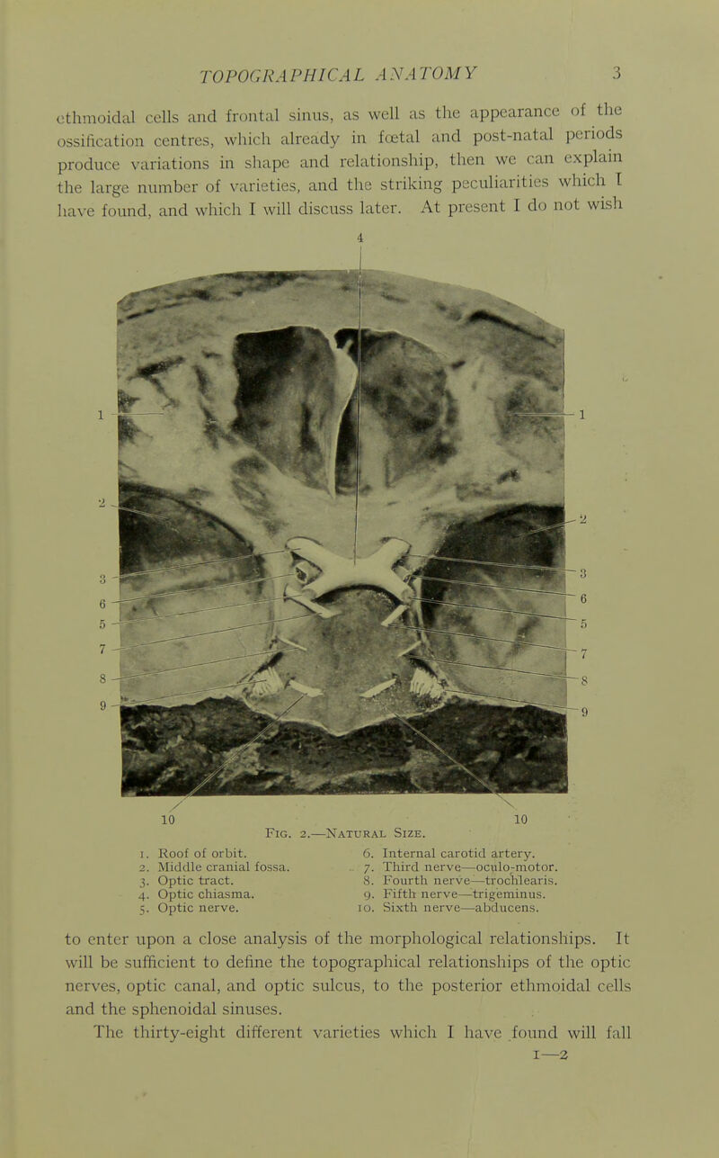 ethmoidal cells and frontal sinus, as well as the appearance of the ossification centres, which already in foetal and post-natal periods produce variations in shape and relationship, then we can explain the large number of varieties, and the striking peculiarities which T liave found, and wliich I will discuss later. At present I do not wisli Fig. 2.—Natural Size. 1. Roof of orbit. 2. Middle cranial fossa. 3. Optic tract. 4. Optic chiasma. 5. Optic nerve. 6. Internal carotid artery. 7. Third nerve—oculo-motor. 8. Fourth nerve—troctaearis. g. Fifth nerve—^trigeminus. lo. Sixth nerve—abducens. to enter upon a close analysis of the morphological relationships. It will be sufficient to define the topographical relationships of the optic nerves, optic canal, and optic sulcus, to the posterior ethmoidal cells and the sphenoidal sinuses. The thirty-eight different varieties which I have found will fall I—2