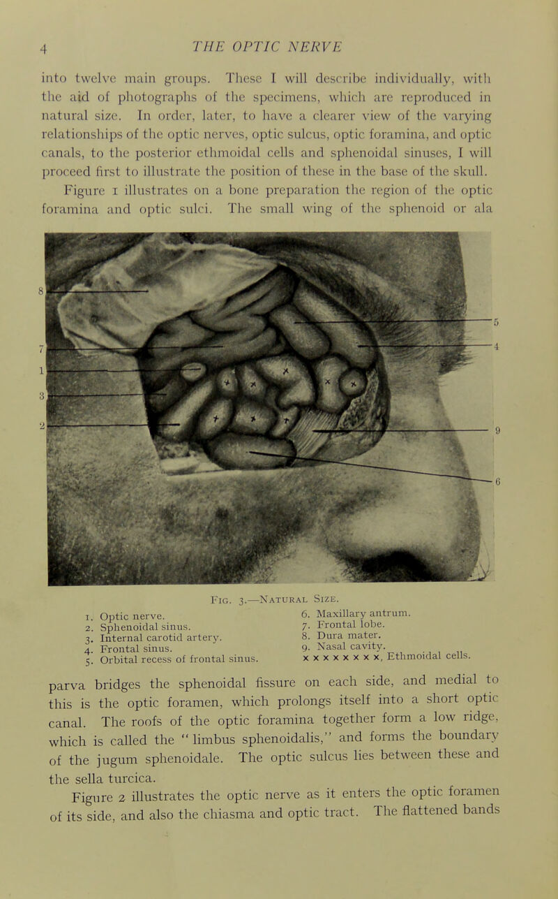 into twelve main groups. These I will describe individually, with the aid of photographs of the specimens, which are reproduced in natural size. In order, later, to have a clearer view of the varying relationships of the optic nerves, optic sulcus, optic foramina, and optic canals, to the posterior ethmoidal cells and sphenoidal sinuses, I will proceed first to illustrate the position of these in the base of the skull. Figure i illustrates on a bone preparation the region of the optic foramina and optic sulci. The small wing of the sphenoid or ala Fig. 3.—Natural Size. I Optic nerve. 6. Maxillary antrum. 2'. Sphenoidal sinus. 7- Frontal lobe. Internal carotid artery. 8. Dura mater. Frontal sinus. 9- Nasal cavity. Orbital recess of frontal sinus. xxxxxxxx, Ethmoidal cells. 3. 4- 5- parva bridges the sphenoidal fissure on each side, and medial to this is the optic foramen, which prolongs itself into a short optic canal. The roofs of the optic foramina together form a low ridge, which is called the  limbus sphenoidalis, and forms the boundary of the jugum sphenoidale. The optic sulcus lies between these and the sella turcica. Figure 2 illustrates the optic nerve as it enters the optic foramen of its side, and also the chiasma and optic tract. The flattened bands