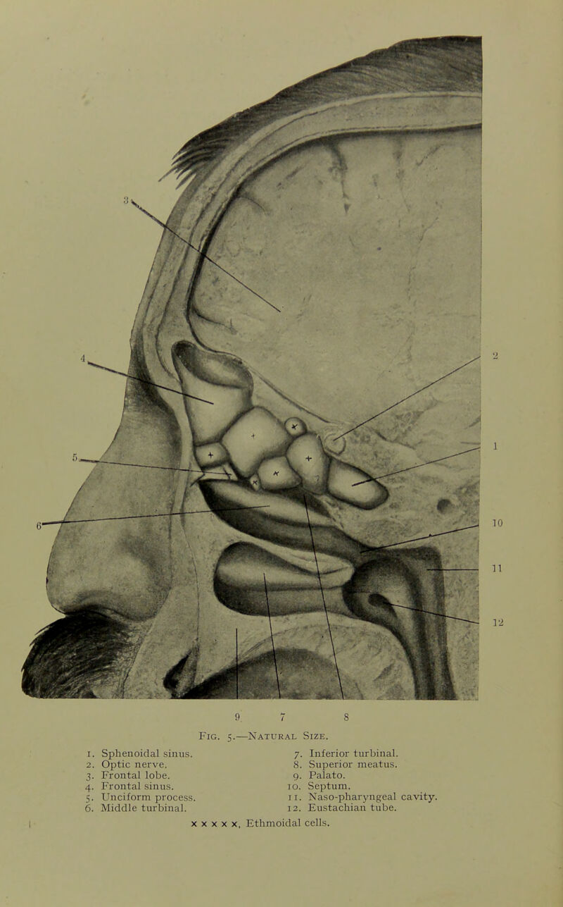 2. Optic nerve. 3. Frontal lobe. 4. Frontal sinus. 5. Unciform process 6. Middle turbinal. 9. 7 8 Fig. 5.—Natural Size. 8. Superior meatus. 9. Palato. 10. Septum. 11. Naso-pharyngeal cavity. 12. Eustachian tube. X X X X X. Ethmoidal cells.