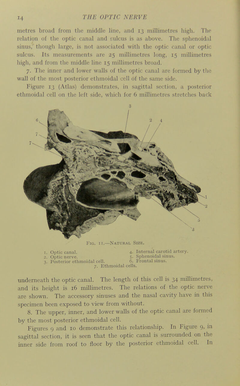 metres broad from the middle line, and 13 millimetres high. The relation of the optic canal and sulcus is as above. The sphenoidal sinus, though large, is not associated with the optic canal or optic sulcus. Its measurements are 25 millimetres long, 15 millimetres high, and from the middle line 15 millimetres broad. 7. The inner and lower walls of the optic canal are formed by the wall of the most posterior ethmoidal cell of the same side. Figure 13 (Atlas) demonstrates, in sagittal section, a posterior ethmoidal cell on the left side, which for 6 millimetres stretches back 3 Fig. II.—Natural Size. 1. Optic canal. 4- Internal carotid artery. 2. Optic nerve. 5- Sphenoidal sinus. 3. Posterior ethmoidal cell. 6. Frontal shius. 7. Ethmoidal cells. underneath the optic canal. The length of this cell is 34 millimetres, and its height is 16 millimetres. The relations of the optic nerve are shown. The accessory sinuses and the nasal cavity have in this specimen been exposed to view from without. 8. The upper, inner, and lower walls of the optic canal are formed by the most posterior ethmoidal cell. Figures 9 and 10 demonstrate this relationship. In Figure 9, in sagittal section, it is seen that the optic canal is surrounded on the inner side from roof to floor by the posterior ethmoidal cell. In