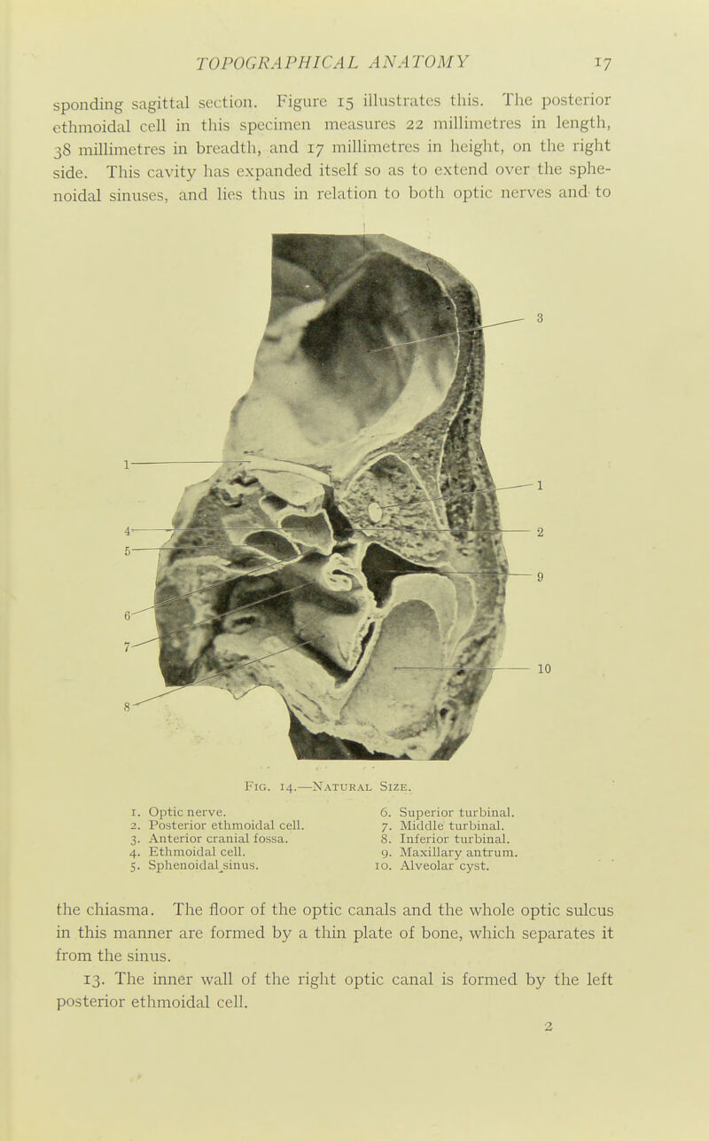 spending sagittal section. Figure 15 illustrates this. The posterior ethmoidal cell in this specimen measures 22 millimetres in length, 38 millimetres in breadth, and 17 millimetres in height, on the right side. This cavity has expanded itself so as to extend over the sphe- noidal sinuses, and lies thus in relation to both optic nerves and to Fig. 14.—Natural Size. 1. Optic nerve. 6. Superior turbinal. 2. Posterior ethmoidal cell. 7. Middle turbinal. 3. Anterior cranial fossa. 8. Inferior turbinal. 4. Ethmoidal cell. 9. Maxillary anti'um. 5. Sphenoidal^sinus. 10. Alveolar cyst. the chiasma. The floor of the optic canals and the whole optic sulcus in this manner are formed by a thin plate of bone, which separates it from the sinus. 13. The inner wall of the right optic canal is formed by the left posterior ethmoidal cell. 2