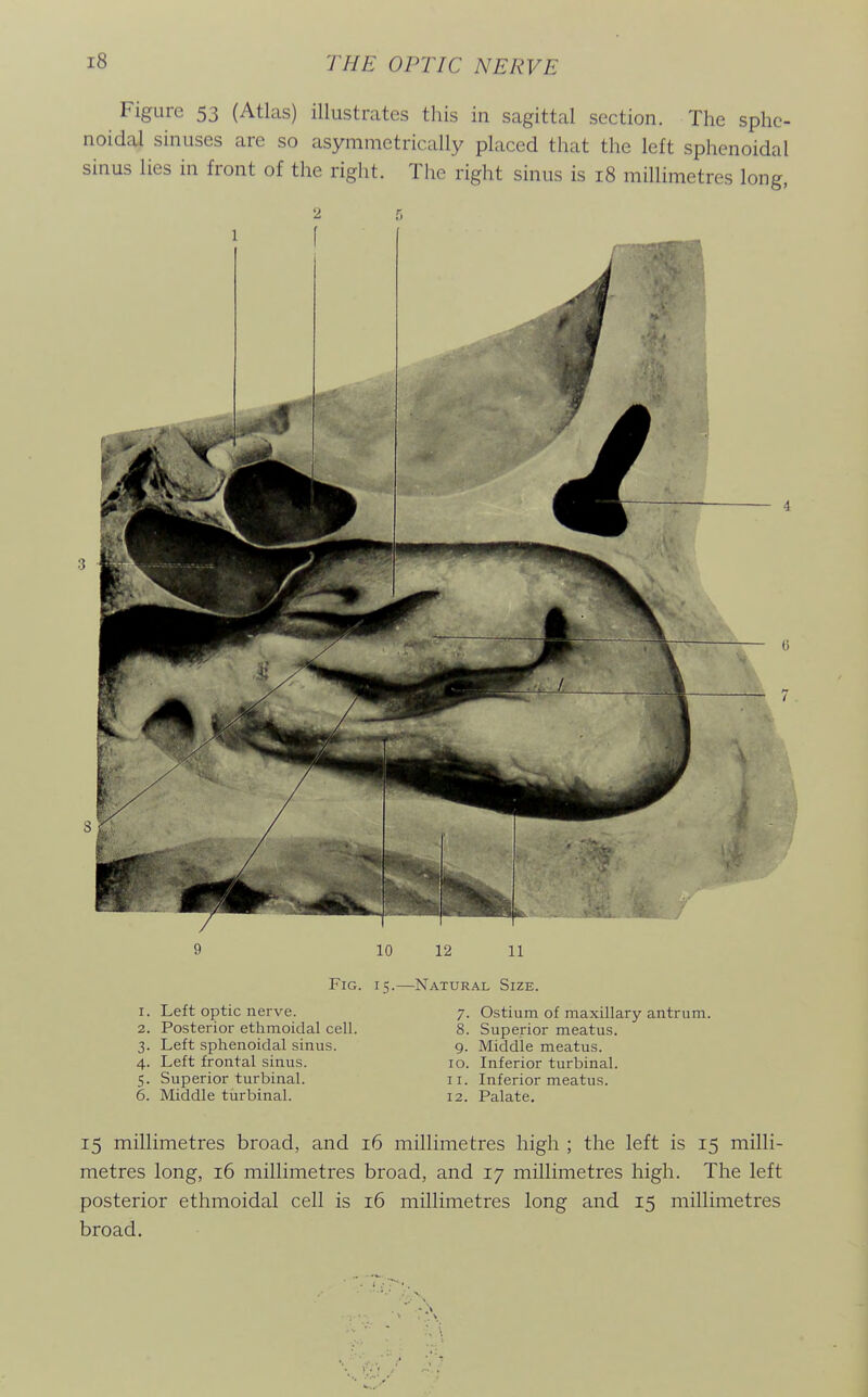 Figure 53 (Atlas) illustrates this in sagittal section. The sphe- noidal sinuses are so asymmetrically placed that the left sphenoidal sinus lies in front of the right. The right sinus is 18 millimetres long, 10 12 11 Fig. I! 1. Left optic nerve. 2. Posterior ethmoidal cell. 3. Left sphenoidal sinus. 4. Left frontal sinus. 5. Superior turbinal. 6. Middle tiirbinal. -Natural Size. 7. Ostium of maxillary antrum. 8. Superior meatus. 9. Middle meatus. 10. Inferior turbinal. 11. Inferior meatus. 12. Palate, 15 millimetres broad, and 16 millimetres high ; the left is 15 milli- metres long, 16 millimetres broad, and 17 millimetres high. The left posterior ethmoidal cell is 16 millimetres long and 15 millimetres broad.