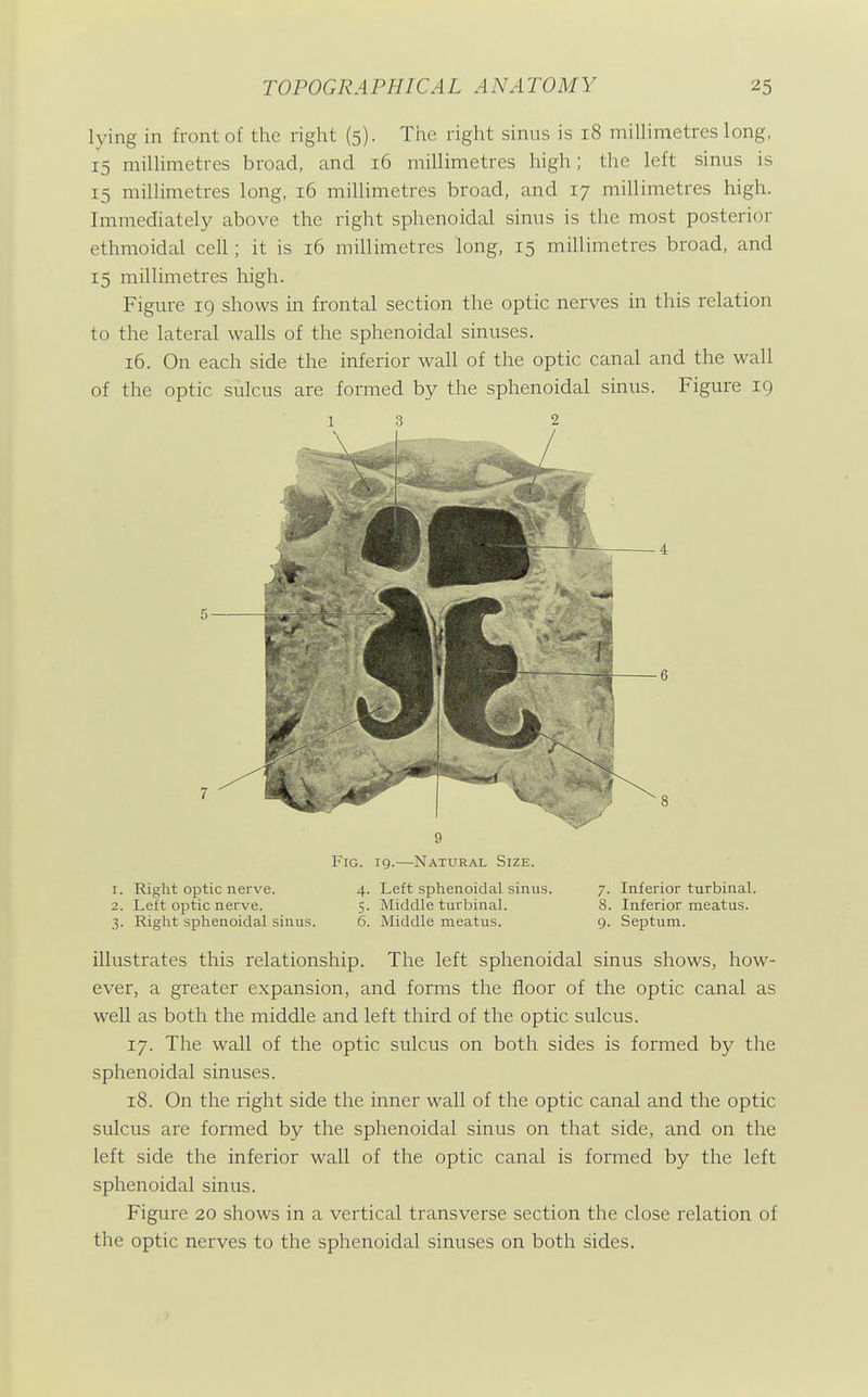 lying in front of the right (5). The right sinus is 18 millimetres long, 15 millimetres broad, and 16 millimetres high; the left sinus is 15 millimetres long, 16 millimetres broad, and 17 millimetres high. Immediately above the right sphenoidal sinus is the most posterior ethmoidal cell; it is 16 millimetres long, 15 millimetres broad, and 15 millimetres high. Figure 19 shows in frontal section the optic nerves in this relation to the lateral walls of the sphenoidal sinuses. 16. On each side the inferior wall of the optic canal and the wall of the optic sulcus are formed by the sphenoidal sinus. Figure 19 13 2 Fig. 19.—Natural Size. 1. Right optic nerve. 4. Left sphenoidal sinus. 7. Inferior turbinal. 2. Left optic nerve. 5. Middle turbinal. 8. Inferior meatus. 3. Right sphenoidal sinus. 6. Middle meatus. 9. Septum. illustrates this relationship. The left sphenoidal sinus shows, how- ever, a greater expansion, and forms the floor of the optic canal as well as both the middle and left third of the optic sulcus. 17. The wall of the optic sulcus on both sides is formed by the sphenoidal sinuses. 18. On the right side the inner wall of the optic canal and the optic sulcus are formed by the sphenoidal sinus on that side, and on the left side the inferior wall of the optic canal is formed by the left sphenoidal sinus. Figure 20 shows in a vertical transverse section the close relation of the optic nerves to the sphenoidal sinuses on both sides.