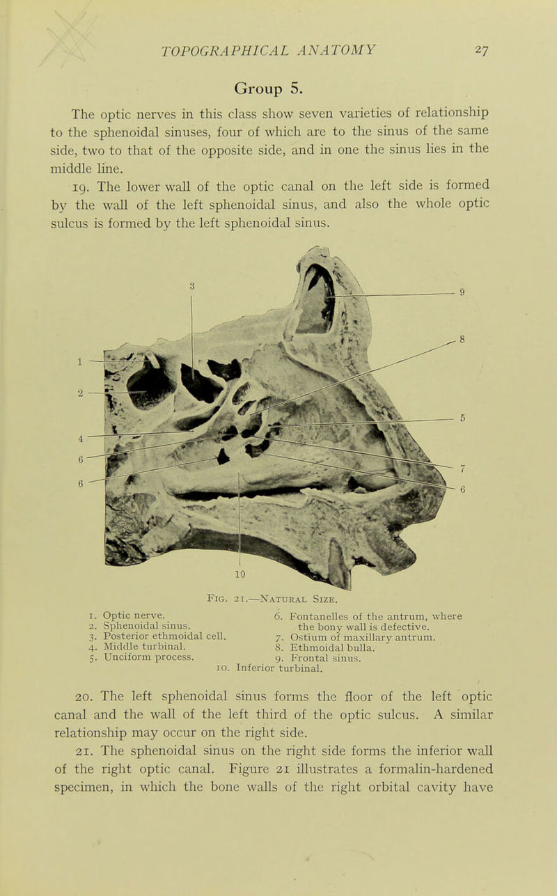 Group 5. The optic nerves in this class show seven varieties of relationship to the sphenoidal sinuses, four of which are to the sinus of the same side, two to that of the opposite side, and in one the sinus lies in the middle line. 19. The lower wall of the optic canal on the left side is formed by the wall of the left sphenoidal sinus, and also the whole optic sulcus is formed by the left sphenoidal sinus. Fig. 21.—Natural Size. 1. Optic nerve. 6. Fontanelles of the antrum, where 2. Sphenoidal sinus. the bony wall is defective. 3. Posterior ethmoidal cell. 7. Ostium of maxillary antrum. 4. Middle turbinal. 8. Ethmoidal bulla. 5. Unciform process. 9. Frontal sinus. 10. Inferior turbinal. 20. The left sphenoidal sinus forms the floor of the left optic canal and the wall of the left third of the optic sulcus. A similar relationship may occur on the right side. 21. The sphenoidal sinus on the right side forms the inferior wall of the right optic canal. Figure 21 illustrates a formalin-hardened specimen, in which the bone walls of the right orbital cavity have