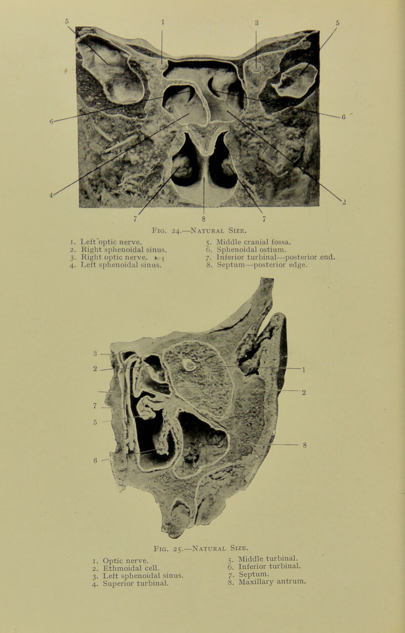 Fig. 25.—Natural Size. 1. Optic nerve. 5- Middle turbinal. 2. Ethmoidal cell. 6. Inferior turbinal. 3. Left sphenoidal sinus. 7- Septum.