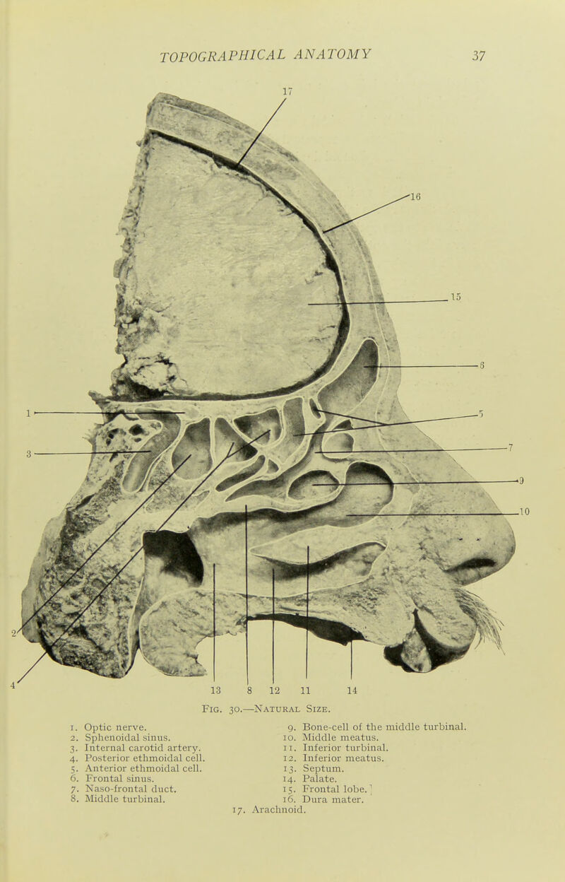 Fig. 30.—Natural Size. 1. Optic nerve. 2. Sphenoidal sinus. 3. Internal carotid artery. 4. Posterior ethmoidal cell. 5. Anterior ethmoidal cell. 6. Frontal sinus. 7. Naso-frontal duct. 8. Middle turbinal. 9. 10. II. 12. 13- 14. IS- 16. 17. Arachnoid. Bone-cell of the middle turbinal. Middle meatus. Inferior turbinal. Inferior meatus. Se^Dtum. Palate. Frontal lobe. ^ Dura mater.