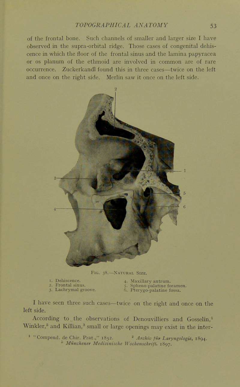 of the frontal bone. Such channels of smaller and larger size I have observed in the supra-orbital ridge. Those cases of congenital dehis- cence in which the floor of the frontal sinus and the lamina papyracea or OS planum of the ethmoid are involved in common are of rare occurrence. Zuckerkandl found this in three cases—twice on the left and once on the right side. Merlin saw it once on the left side. Fig. 38.—Natural Size. 1. Dehiscence. 2. Frontal sinus. 3. Lachrymal groove. 4. Maxillary antrum. 5. Spheno-palatine foramen. 6. Pterygo-palatine fossa. I have seen three such cases—twice on the right and once on tlie left side. According to, the observations of Denouvilliers and Gosselin,^ Winkler,2 and Killian,^ small or large openings may exist in the inter- ^ Compend. de Chir. Prat., 1852. 2 ^ychiv fiiy Laryngologie, 1894.  Miinchenev Medizinische Wochenschrift, 1897.