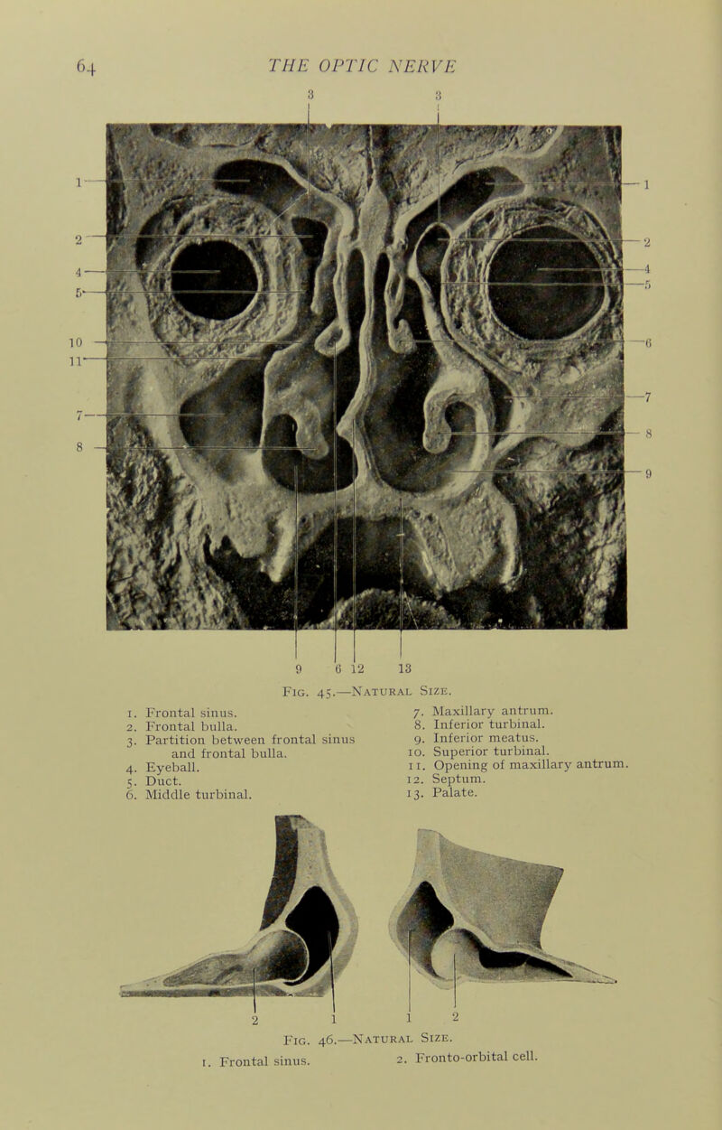 9 (3 12 13 Fig. 45.—Natural Size. 3- 1. Frontal sinus. 2. Frontal bulla. Partition between frontal sinus and frontal bulla. 4. Eyeball. 5. Duct. 6. Middle turbinal. 7. Maxillary antrum. 8. Inferior turbinal. 9. Inferior meatus. 10. Superior turbinal. 11. Opening of maxillary antrum 12. Septum. 13. Palate. 2 1 P'iG. 46.—Natural Size. I. Frontal sinus. 2. Fronto-orbital cell.