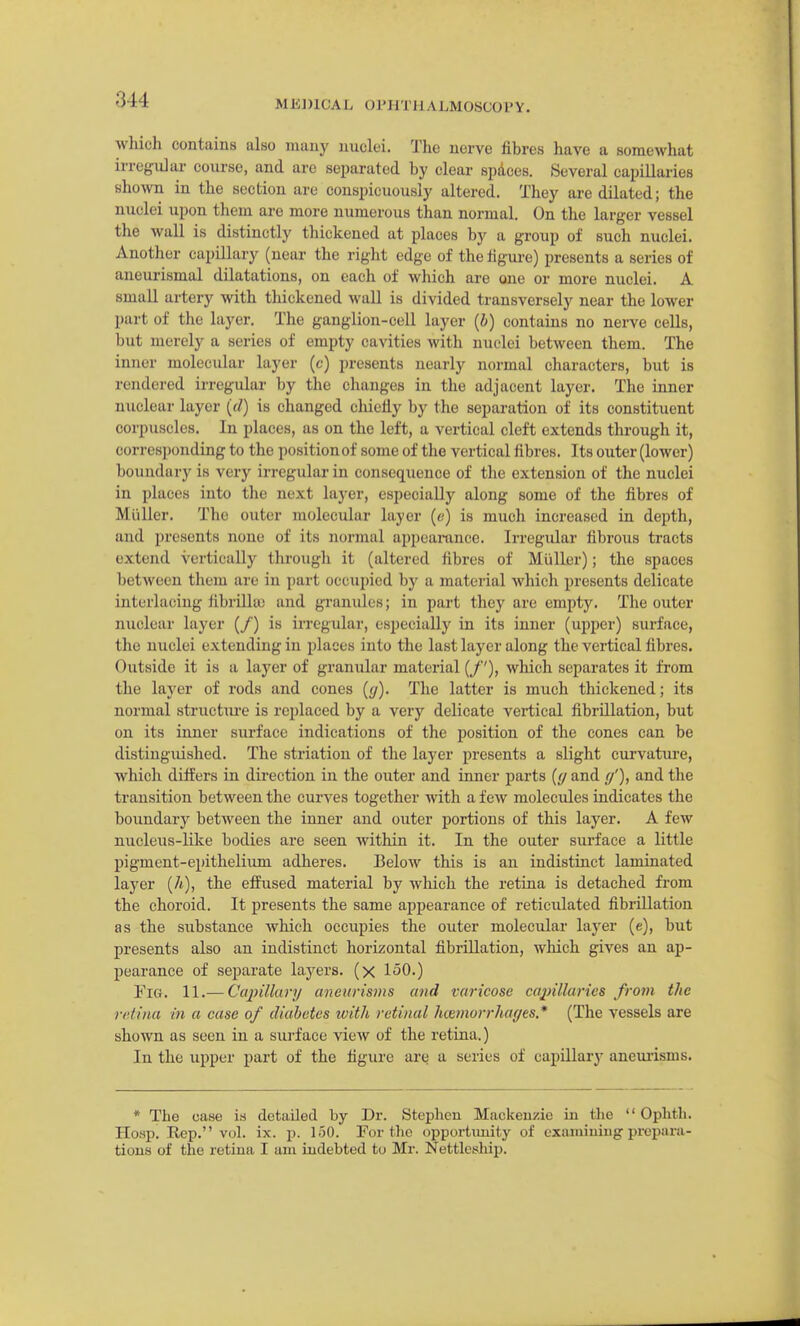 which contains also many nuclei. The nerve fibres have a somewhat irregular course, and are separated by clear spAces. Several capillaries shown in the section are conspicuously altered. They are dilated; the nuclei upon them are more numerous than normal. On the larger vessel the wall is distinctly thickened at places by a group of such nuclei. Another capillary (near the right edge of the figure) presents a series of aneurismal dilatations, on each of which are one or more nuclei. A small artery with thickened wall is divided transversely near the lower part of the layer. The ganglion-cell layer (i) contains no nerve cells, but merely a series of empty cavities with nuclei between them. The inner molecular layer (c) presents nearly normal characters, but is rendered irregular by the changes in the adjacent layer. The inner nuclear layer [d) is changed chiefly by the separation of its constituent corpuscles. In places, as on the left, a vertical cleft extends tlu-ough it, corresponding to the position of some of the vertical fibres. Its outer (lower) boundary is very irregular in consequence of the extension of the nuclei in places into tlie next layer, especially along some of the fibres of Miiller. The outer molecular layer (e) is much increased in depth, and presents none of its normal appeamnce. Irregular fibrous tracts extend vertically through it (altered fibres of Miiller); the spaces between tliem are in part occupied by a material which presents delicate interlacing fibrilla) and granidcs; in part they are empty. The outer nuclear layer (/) is irregular, especially in its inner (upper) surface, the nuclei extending in places into the last layer along the vertical fibres. Outside it is a layer of granular material (/'), wliich separates it from the layer of rods and cones (</). The latter is much thickened; its normal structm-e is replaced by a very delicate vertical fibrillation, but on its inner surface indications of the position of the cones can be distiugidshed. The striation of the layer presents a slight curvature, which differs in direction in the outer and inner parts (yand f/'), and the transition between the curves together with a few molecules indicates the boundary betAveen the inner and outer portions of this layer. A few micleus-like bodies are seen within it. In the outer surface a little pigment-epithelium adheres. Below this is an indistinct laminated layer (/«), the effused material by wliich the retina is detached from the choroid. It presents the same appearance of reticulated fibrillation as the substance whicli occupies the outer molecular layer (e), but presents also an indistinct horizontal fibrillation, which gives an ap- pearance of separate layers, (x 150.) Fig. 11.— Capillary aneurisms and varicose ca^nllarics from the rrfina in a case of diabetes with retinal hcemorrhages* (The vessels are shown as seen in a suii'ace vieAV of the retina.) In the upper part of the figure are a series of capillary anem-isms. * The case is detailed by Dr. Stephen Mackenzie in the Oplith. Ho.sp. Rep. vol. ix. p. 150. For the opportimity of examining prepara- tions of the retina I am indebted to Mr. Nettleship.