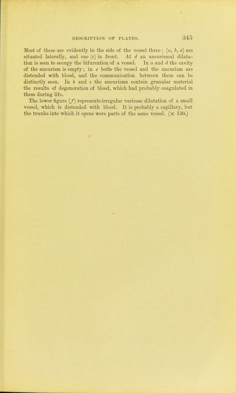 Most of these are evidently in tlie side of the vessel three ; («, b, e) are situated laterally, and one (c) in front. At d an anenrismal dilata- tion is seen to occupy the bifui-cation of a vessel. In a and d the cavity of the aneurism is empty; in e both» the vessel and the aneurism are distended with blood, and the communication between them can be distinctly seen. In b and c the aneurisms contain granular material the results of degeneration of blood, which had probably coagulated in them during Ufe. The lower figure (/) represents irregular varicose dilatation of a smaU vessel, which is distended with blood. It is probably a capillary, but the trunks into which it opens were parts of the same vessel. (X 150.)