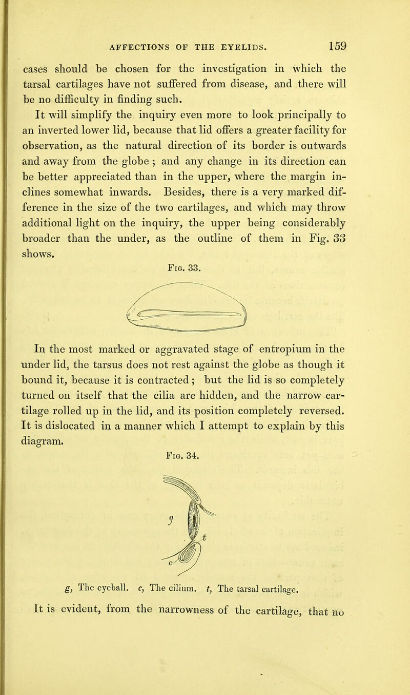 cases should be chosen for the investigation in which the tarsal cartilages have not suffered from disease, and there will be no difficulty in finding such. It will simplify the inquiry even more to look principally to an inverted lower lid, because that lid offers a greater facility for observation, as the natural direction of its border is outwards and away from the globe ; and any change in its direction can be better appreciated than in the upper, where the margin in- clines somewhat inwards. Besides, there is a very marked dif- ference in the size of the two cartilages, and which may throw additional light on the inquiry, the upper being considerably broader than the under, as the outline of them in Fig. 33 shows. Fig. 33. In the most marked or aggravated stage of entropium in the under lid, the tarsus does not rest against the globe as though it bound it, because it is contracted ; but the lid is so completely turned on itself that the cilia are hidden, and the narrow car- tilage rolled up in the lid, and its position completely reversed. It is dislocated in a manner which I attempt to explain by this diagram. Fig. 34. g, The eyeball, c, The cilium. t, The tarsal cartilage. It is evident, from the narrowness of the cartilage, that no