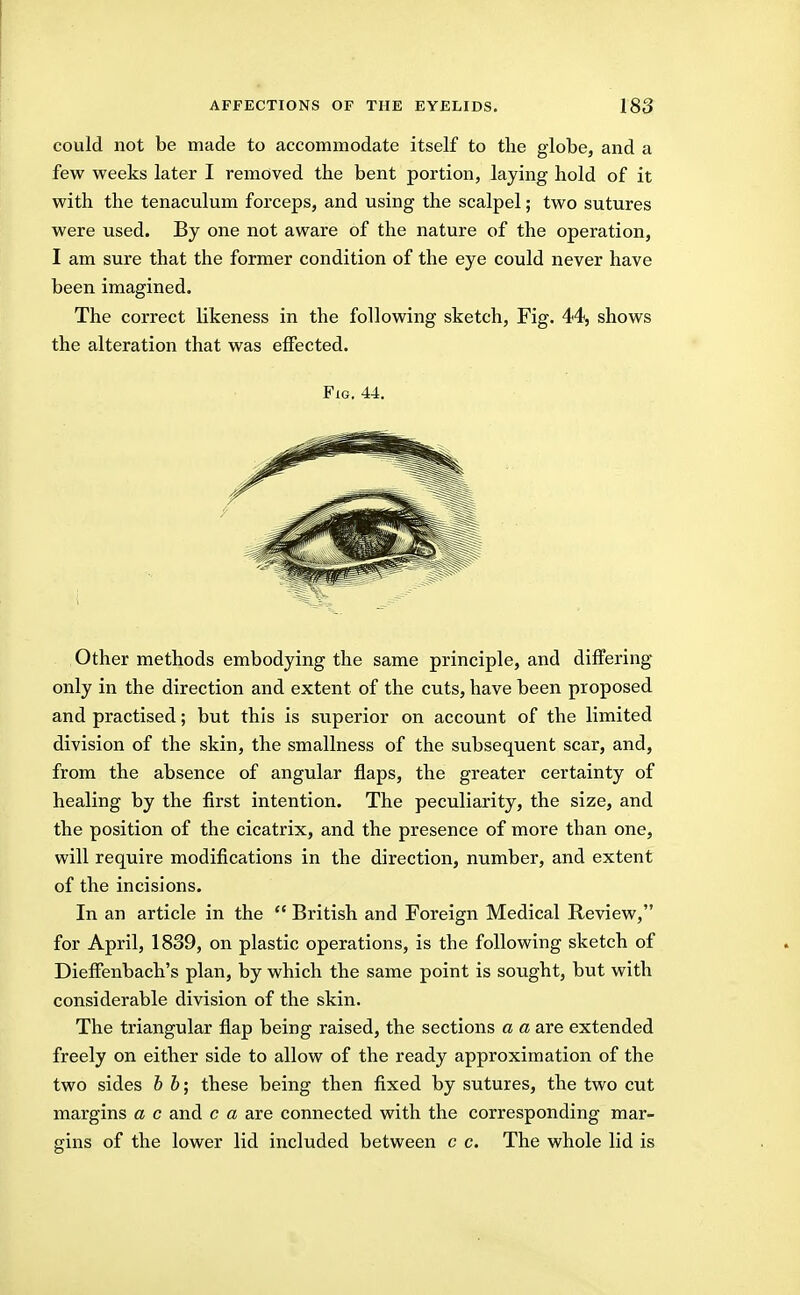 could not be made to accommodate itself to the globe, and a few weeks later I removed the bent portion, laying hold of it with the tenaculum forceps, and using the scalpel; two sutures were used. By one not aware of the nature of the operation, I am sure that the former condition of the eye could never have been imagined. The correct likeness in the following sketch. Fig. 44, shows the alteration that was effected. Fig. 44. Other methods embodying the same principle, and differing only in the direction and extent of the cuts, have been proposed and practised; but this is superior on account of the limited division of the skin, the smallness of the subsequent scar, and, from the absence of angular flaps, the greater certainty of healing by the first intention. The peculiarity, the size, and the position of the cicatrix, and the presence of more than one, will require modifications in the direction, number, and extent of the incisions. In an article in the  British and Foreign Medical Review, for April, 1839, on plastic operations, is the following sketch of Dieffenbach's plan, by which the same point is sought, but with considerable division of the skin. The triangular flap being raised, the sections a a are extended freely on either side to allow of the ready approximation of the two sides b b; these being then fixed by sutures, the two cut margins a c and c a are connected with the corresponding mar- gins of the lower lid included between c c. The whole lid is