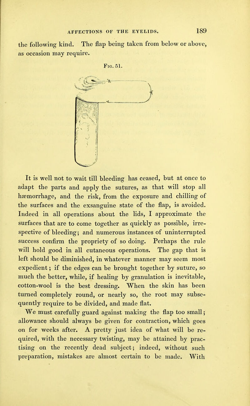 the following kind. The flap being taken from below or above, as occasion may require. Fig. 51. It is well not to wait till bleeding has ceased, but at once to adapt the parts and apply the sutures, as that will stop all haemorrhage, and the risk, from the exposure and chilling of the surfaces and the exsanguine state of the flap, is avoided. Indeed in all operations about the lids, I approximate the surfaces that are to come together as quickly as possible, irre- spective of bleeding; and numerous instances of uninterrupted success confirm the propriety of so doing. Perhaps the rule will hold good in all cutaneous operations. The gap that is left should be diminished, in whatever manner may seem most expedient; if the edges can be brought together by suture, so much the better, while, if healing by granulation is inevitable, cotton-wool is the best dressing. When the skin has been turned completely round, or nearly so, the root may subse- quently require to be divided, and made flat. We must carefully guard against making the flap too small; allowance should always be given for contraction, which goes on for weeks after. A pretty just idea of what will be re- quired, with the necessary twisting, may be attained by prac- tising on the recently dead subject; indeed, without such preparation, mistakes are almost certain to be made. With