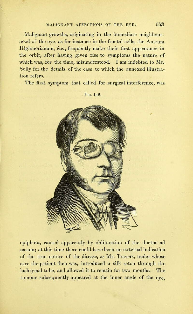 Malignant growths, originating in the immediate neighbour- liood of the eye, as for instance in the frontal cells, the Antrum Highmorianum, &c., frequently make their first appearance in the orbit, after having given rise to symptoms the nature of which was, for the time, misunderstood. I am indebted to Mr. Solly for the details of the case to which the annexed illustra- tion refers. The first symptom that called for surgical interference, was Fig. 142. epiphora, caused apparently by obliteration of the ductus ad nasum; at this time there could have been no external indication of the true nature of the disease, as Mr. Travers, under whose care the patient then was, introduced a silk seton through the lachrymal tube, and allowed it to remain for two months. The tumour subsequently appeared at the inner angle of the eye,