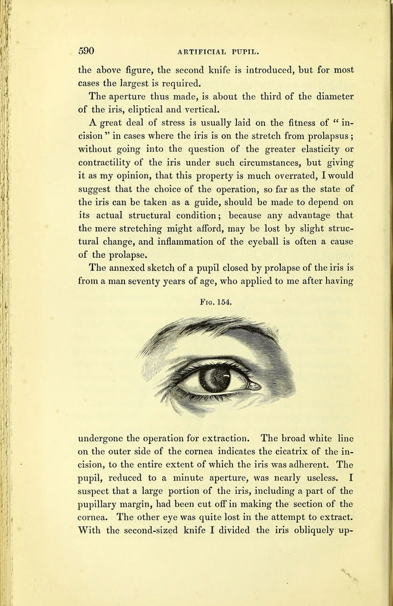 the above figure, the second knife is introduced, but for most cases the largest is required. The aperture thus made, is about the third of the diameter of the iris, eliptical and vertical. A great deal of stress is usually laid on the fitness of  in- cision  in cases where the iris is on the stretch from prolapsus; without going into the question of the greater elasticity or contractility of the iris under such circumstances, but giving it as my opinion, that this property is much overrated, I would suggest that the choice of the operation, so far as the state of the iris can be taken as a guide, should be made to depend on its actual structural condition; because any advantage that the mere stretching might afford, may be lost by slight struc- tural change, and inflammation of the eyeball is often a cause of the prolapse. The annexed sketch of a pupil closed by prolapse of the iris is from a man seventy years of age, who applied to me after having Fig. 154. undergone the operation for extraction. The broad white line on the outer side of the cornea indicates the cicatrix of the in- cision, to the entire extent of which the iris was adherent. The pupil, reduced to a minute aperture, was nearly useless. I suspect that a large portion of the iris, including a part of the pupillary margin, had been cut off in making the section of the cornea. The other eye was quite lost in the attempt to extract. With the second-sized knife I divided the iris obliquely up-