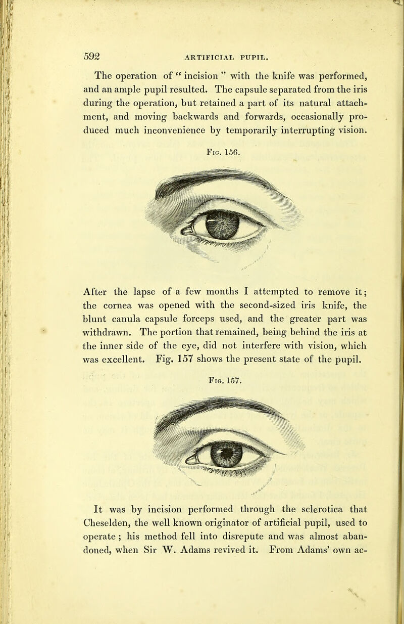 The operation of  incision  with the knife was performed, and an ample pupil resulted. The capsule separated from the iris during the operation, but retained a part of its natural attach- ment, and moving backwards and forwards, occasionally pro- duced much inconvenience by temporarily interrupting vision. Fig. 156. After the lapse of a few months I attempted to remove it; the cornea was opened with the second-sized iris knife, the blunt canula capsule forceps used, and the greater part was withdrawn. The portion that remained, being behind the iris at the inner side of the eye, did not interfere with vision, which was excellent. Fig. 157 shows the present state of the pupil. Fig. 157. It was by incision performed through the sclerotica that Cheselden, the well known originator of artificial pupil, used to operate ; his method fell into disrepute and was almost aban- doned, when Sir W. Adams revived it. From Adams' own ac-