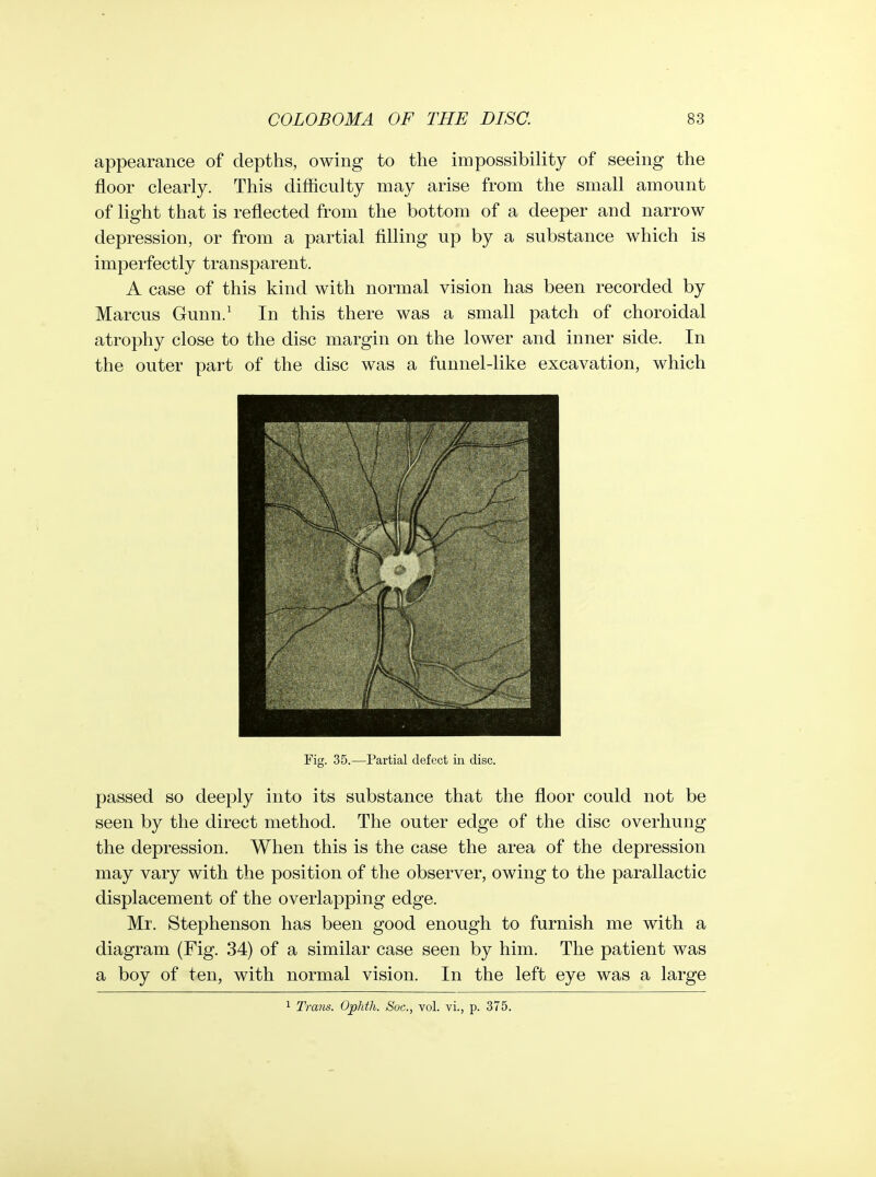 appearance of depths, owing to the impossibility of seeing the floor clearly. This diflSculty may arise from the small amount of light that is reflected from the bottom of a deeper and narrow depression, or from a partial filling up by a substance which is imperfectly transparent. A case of this kind with normal vision has been recorded by Marcus Gunn.^ In this there was a small patch of choroidal atrophy close to the disc margin on the lower and inner side. In the outer part of the disc was a funnel-like excavation, which passed so deeply into its substance that the floor could not be seen by the direct method. The outer edge of the disc overhung the depression. When this is the case the area of the depression may vary with the position of the observer, owing to the parallactic displacement of the overlapping edge. Mr. Stephenson has been good enough to furnish me with a diagram (Fig. 34) of a similar case seen by him. The patient was a boy of ten, with normal vision. In the left eye was a large Fig. 35.—Partial defect in disc. 1 Trans. Oplith. Soc, vol. vi., p. 375.