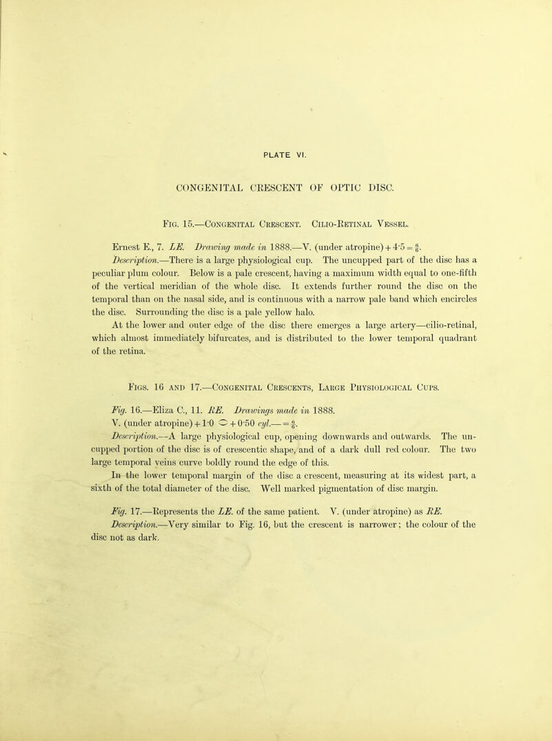 CONGENITAL CRESCENT OF OPTIC DISC. Fig. 15.—Congenital Crescent. Cilio-Retinal Vessel. Ernest E., 7. LE. Drawing made in 1888.—V. (under atropine) + 4'5 = f. Description.—There is a large physiological cup. The uncupped part of the disc has a peculiar plum colour. Below is a pale crescent, having a maximum width equal to one-fifth of the vertical meridian of the whole disc. It extends further round the disc on the temporal than on the nasal side, and is continuous with a narrow pale band which encircles the disc. Surrounding the disc is a pale yellow halo. At the lower and outer edge of the disc there emerges a large artery—cilio-retinal, which almost immediately bifurcates, and is distributed to the lower temporal quadrant of the retina. Figs. 16 and 17.—Congenital Crescents, Large Physiological Cups. Fig. 16.—Eliza C, 11. RE. Drawings made in 1888. V. (under atropine) + I'O O + 0'50 cyl,— = f. Description.—A large physiological cup, opening downwards and outwards. The un- cupped portion of the disc is of crescentic shape, and of a dark dull red colour. The two large temporal veins curve boldly round the edge of this. In the lower temporal margin of the disc a crescent, measuring at its widest part, a sixth of the total diameter of the disc. Well marked pigmentation of disc margin. Fig. 17.—Represents the LE. of the same patient. V. (under atropine) as RE. Description.—Very similar to Fig. 16, but the crescent is narrower; the colour of the disc not as darlv.