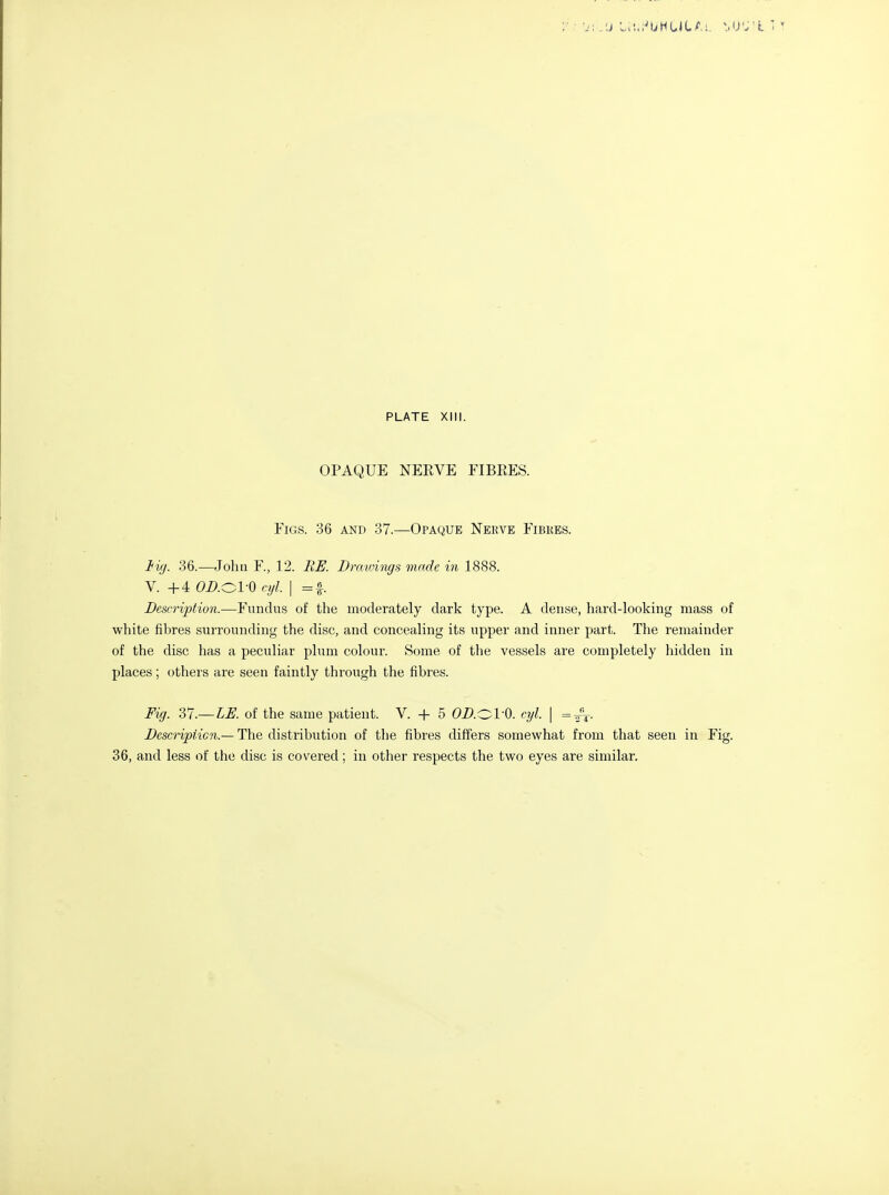 OPAQUE NEEVE FIBRES. Figs. 36 and 37.—Opaque Nekve Fibres. 36.—John F., 12. RE. Draioimjs made in 1888. V. +4 OZ'.Ol-O cyl. I =f. Description.—Fundus of the moderately dark type. A dense, hard-looking mass of white fibres surrounding the disc, and concealing its upper and inner part. The remainder of the disc has a peculiar plum colour. Some of the vessels are completely hidden in places; others are seen faintly through the fibres. Fig. ?,1.— LE. of the same patient. V. + 5 OD.^VO. cyl. \ =4k- Descripiicn.— The distribution of the fibres differs somewhat from that seen in Fig. 36, and less of the disc is covered; in other respects the two eyes are similar.