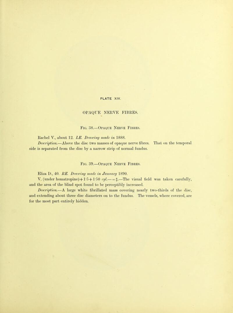 OPAQUE NEEVE FIBRES. Fig. 38.—Opaque Nerve Fibres. Eachel V., about 12. LE. Drawing made in 1888. Description.—Above the disc two masses of opaque nerve fibres. Tliat on the temporal side is separated from the disc by a narrow strip of normal fundus. Fig. 39.—Opaque Nerve Fibres. Eliza D., 40. RE. Draivimj made in Januarg 1890. V. (under homatropine) + l'5 + 1'50 cyl.— = f.—^The visual field was taken carefully, and the area of the blind spot found to be perceptibly increased. Description.—A large white fibrillated mass covering nearly two-thirds of the disc, and extending about three disc diameters on to the fundus. The vessels, where covered, are for the most part entirely hidden.