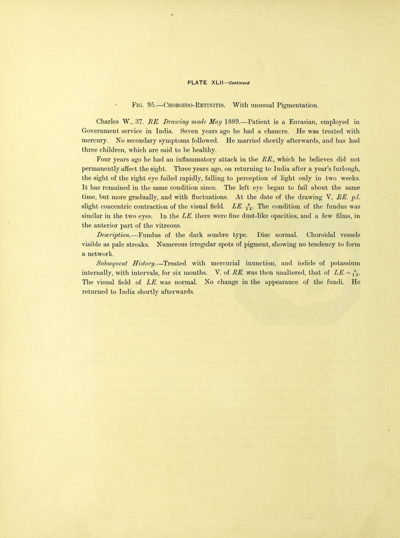 Fig. 95.—Choroido-Eetinitis. With unusual Pigmentation. Charles W., 37. BU. Drawing made May 1889.—Patient is a Eurasian, employed in Government service in India. Seven years ago he had a chancre. He was treated with mercury. No secondary symptoms followed. He married shortly afterwards, and has had three children, which are said to be healthy. Four years ago he had an inflammatory attack in the BK, which he believes did not permanently affect the sight. Three years ago, on returning to India after a year's furlough, the sight of the right eye failed rapidly, falling to perception of light only in two weeks. It has remained in the same condition since. The left eye began to fail about the same time, but more gradually, and with fluctuations. At the date of the drawing V. EK p.l. slight concentric contraction of the visual field. ZK The condition of the fundus was similar in the two eyes. In the LE. there were fine dust-like opacities, and a few films, in the anterior part of the vitreous. Description.—Fundus of the dark sombre type. Disc normal. Choroidal vessels visible as pale streaks. Numerous irregular spots of pigment, showing no tendency to form a network. Suhsecfimit History.—Treated with mercurial inunction, and iodide of potassium internally, with intervals, for six months. V. of RE. was then unaltered, that of LE. = The visual field of LE. was normal. No change in the appearance of the fundi. He returned to India shortly afterwards.