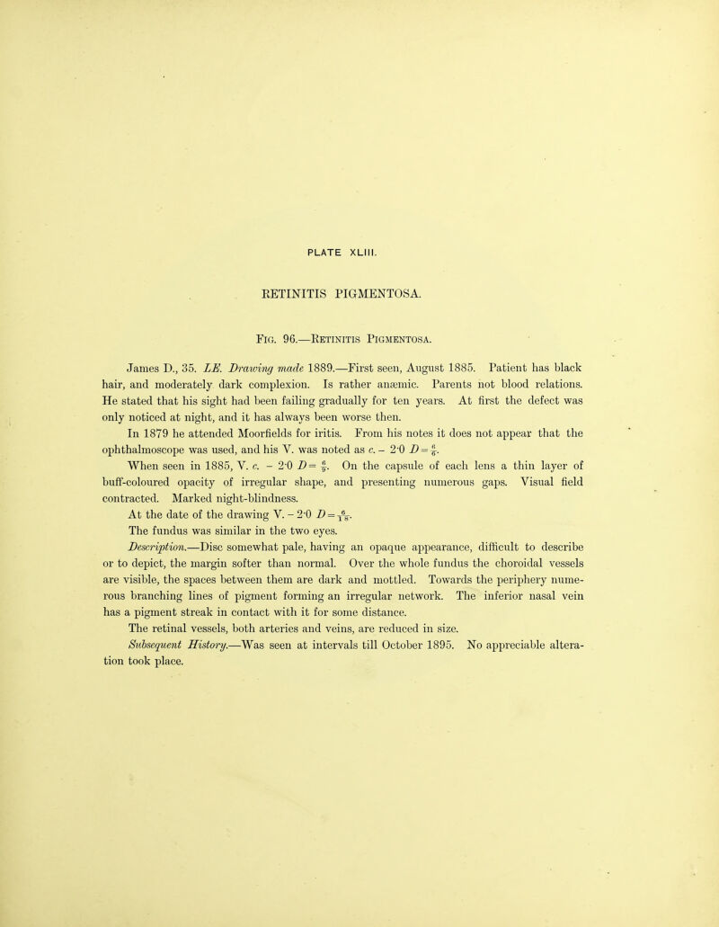 KETINITIS PIGMENTOSA. Fig. 96.—Retinitis Pigmentosa. James D., 35. LE. Drawing made 1889.—First seen, August 1885. Patient has black hair, and moderately dark complexion. Is rather antemic. Parents not blood relations. He stated that his sight had been failing gradually for ten years. At first the defect was only noticed at night, and it has always been worse then. In 1879 he attended Moorfields for iritis. From his notes it does not appear that the ophthalmoscope was used, and his V. was noted as c. - 2'0 JD='^. When seen in 1885, V. c. - 20 D= ^. On the capsule of each lens a thin layer of buff-coloured opacity of irregular shape, and presenting numerous gaps. Visual field contracted. Marked night-blindness. At the date of the drawing V. - 2-0 D = ^^. The fundus was similar in the two eyes. Description.—Disc somewhat pale, having an opaque appearance, difficult to describe or to depict, the margin softer than normal. Over the whole fundus the choroidal vessels are visible, the spaces between them are dark and mottled. Towards the periphery nume- rous branching lines of pigment forming an irregular network. The inferior nasal vein has a pigment streak in contact with it for some distance. The retinal vessels, both arteries and veins, are reduced in size. Subsequent History.—Was seen at intervals till October 1895. No appreciable altera- tion took place.