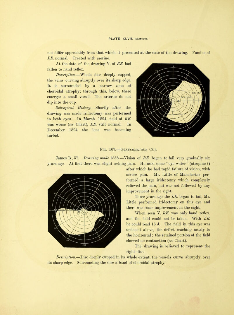 not differ appreciably from that which it presented at the date of the drawing. ZU. normal. Treated with eserine. At the date of the drawing V. of BE. had fallen to hand reflex. Descripf/ion.—Whole disc deeply cupped, the veins curving abruptly over its sharp edge. It is surrounded by a narrow zone of choroidal atrophy; through this, below, there emerges a small vessel. The arteries do not dip into the cup. Subsequc7it History.—Shortly after the drawing was made iridectomy was performed in both eyes. In March 1894, field of BU. was worse (see Chart), LU. still normal. In December 1894 the lens was becoming turbid. Fundus of Fig. 107.—Glaucomatous Cup. James B., 57. Drawing made 1888.—Vision of B£J. began to fail very gradually six years ago. At first there was slight aching pain. He used some eye-water (atropine ?) after which he had rapid failure of vision, with severe pain. Mr. liittle of Manchester per- formed a large iridectomy which completely relieved the pain, but was not followed by any improvement in the sight. Three years ago the ZU. began to fail, Mr. Little performed iridectomy on this eye and there was some improvement in the sight. When seen V. BK was only hand reflex, and the field could not be taken. With Z£J. he could read 16 J. The field in this eye was deficient above, the defect reaching nearly to the horizontal; the retained portion of the field showed no contraction {see Chart). The drawing is believed to represent the right disc. description.—Disc deeply cupped in its whole extent, the vessels curve abruptly over its sharp edge. Surrounding the disc a band of choroidal atrophy.