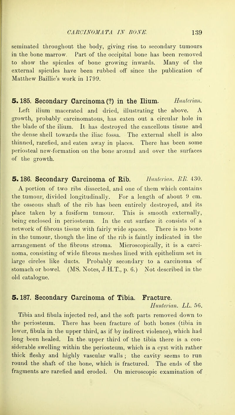 seminated throughout the body, giving rise to secondary tumoars in the bone marrow. Part of the occipital bone has been removed to show the spicules of bone growing inwards. Many of the external spicules have been rubbed off since the publication of Matthew Baillie's work in 1799. . . 5.185. Secondary Carcinoma (?) in the Ilium. Hmterian. Left ilium macerated and dried, illustrating the above. A growth, probably carcinomatous, has eaten out a circular hole in the blade of the ilium. It has destroyed the cancellous tissue and the dense shell towards the iliac fossa. The external shell is also thinned, rarefied, and eaten away in places. There has been some periosteal new-formation on the bone around and over the surfaces of the growth. 5.186. Secondary Carcinoma of Rib. Hunterian. EB. 430. A portion of two ribs dissected, and one of them which contains the tumour, divided longitudinally. For a length of about 9 cm. the osseous shaft of the rib has been entirely destroyed, and its place taken by a fusiform tumour. This is smooth externally, being enclosed in periosteum. In the cut surface it consists of a network of fibrous tissue with fairly wide spaces. There is no bone in the tumour, though the line of the rib is faintly indicated in the arrangement of the fibrous stroma. Microscopically, it is a carci- noma, consisting of wide fibrous meshes lined with epithelium set in large circles like ducts. Probably secondary to a carcinoma of stomach or bowel. (MS. Notes, J.H.T., p. 6.) Not described in the old catalogue. 5.187. Secondary Carcinoma of Tibia. Fracture. Hunterian. LL. 56. Tibia and fibula injected red, and the soft parts removed down to the periosteum. There has been fracture of both bones (tibia in lower, fibula in the upper third, as if by indirect violence), which had long been healed. In the upper third of the tibia there is a con- siderable sweUing within the periosteum, which is a cyst with rather thick fleshy and highly vascular walls ; the cavity seems to run round the shaft of the bone, which is fractured. The ends of the fragments are rarefied and eroded. On microscopic examination of