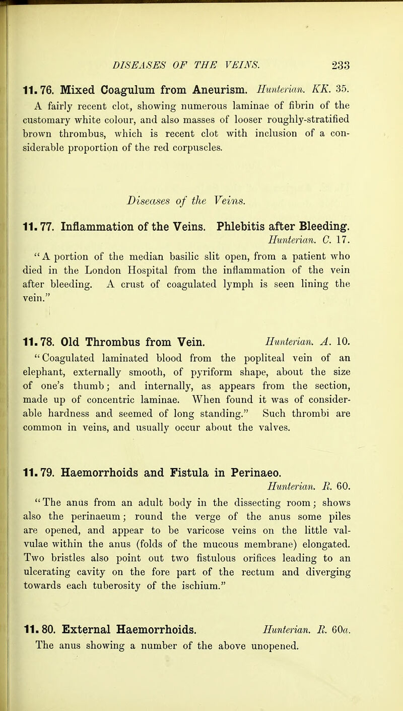 p I DISEASES OF THE VEINS. 233 11.76. Mixed Coagulum from Aneurism. Hunterian. KK. 35. , A fairly recent clot, showing numerous laminae of fibrin of the I customary white colour, and also masses of looser roughly-stratified brown thrombus, which is recent clot with inclusion of a con- siderable proportion of the red corpuscles. I Diseases of the Veins. 11.77. Inflammation of the Veins. Phlebitis after Bleeding. Hunterian. C. 17.  A portion of the median basilic slit open, from a patient who died in the London Hospital from the inflammation of the vein after bleeding. A crust of coagulated lymph is seen lining the |j vein. 11.78. Old Thrombus from Vein. Hunterian. A. 10.  Coagulated laminated blood from the popliteal vein of an elephant, externally smooth, of pyriform shape, about the size of one's thumb; and internally, as appears from the section, made up of concentric laminae. When found it was of consider- able hardness and seemed of long standing. Such thrombi are common in veins, and usually occur about the valves. :< 11.79. Haemorrhoids and Fistula in Perinaeo. Hunterian. R. 60. The anus from an adult body in the dissecting room; shows 1 also the perinaeum; round the verge of the anus some piles 5 are opened, and appear to be varicose veins on the little val- ] vulae within the anus (folds of the mucous membrane) elongated. Two bristles also point out two fistulous orifices leading to an !' ulcerating cavity on the fore part of the rectum and diverging I towards each tuberosity of the ischium. 11.80. External Haemorrhoids. Hunterian. R. %Qa. The anus showing a number of the above unopened. I,