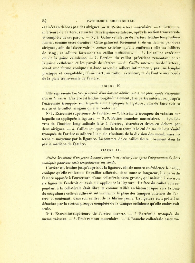 et tirées en dehors par des airignes. — 3. Petite artère musculaire. — 4. Extrémité inférieure de l'artère, rétractée dans la gaine celluleuse, apriBs la section transversale et complète de ses parois. — 5 , 5. Gaîne celluleuse de l'artère fendue longitudina- lement comme cette dernière. Cette gaîne est fortement tirée en dehors par deux airignes , afin de laisser voir le caillot extérieur qu'elle renferme; elle est infiltrée de sang , et adhère fortement au caillot précédent. — 6. Le caillot extérieur ou de la gaîne celluleuse. — 7. Portion du caillot précédent remontant entre la gaîne celluleuse et les parois de l'artère. — 8. Caillot intérieur ou de l'artère, ayant une forme conique : sa-base arrondie adhère intimement, par une lymphe plastique et coagulable , d'une part, au caillot extérieur, et de l'autre aux bords de la plaie transversale de l'artère. FIGURE 10. Elle représente Vartère fémorale d'un homme adulte, mort six jours après l'amputa- lion de la cuisse. L'artère est fendue longitudinalement, à sa partie antérieure, jusqu'à l'extrémité tronquée sur laquelle a été appliquée la ligature , afin de faire voir sa cavité et le caillot sanguin qu'elle renferme, N 1. Extrémité supérieure de l'artère. — 2. Extrémité tronquée du vaisseau sur laquelle est appliquée la ligature. — 3,3. Petites branches musculaires. — 4,4. Lè- vres de l'incision longitudinale faite à l'artère, écartées et tirées en dehors par deux airignes. — 5. Caillot conique dont la base remplit le cul de sac de l'extrémité tronquée de l'artère el adhère à la plaie résultant de la division des membranes in- terne et moyenne par la ligature. Le sommet de ce caillot flotte librement dans la partie médiane de l'artère. FIG l R E 11. Artère brachiale d'un jeune homme, mort le neuvième jour après V amputation du bras pratiquée pour une carie scrophuleuse du coude. L'artère est fendue jusqu'auprès de la ligature, afin de mettre en évidence le caillot conique qu'elle renferme. Ce caillot adhérait, dans toute sa longueur, à la paroi de l'artère opposée à l'ouverture d'une collatérale assez grosse, qui naissait à environ six lignes de l'endroit où avait été appliquée la ligature. La face du caillot corres- pondant à la collatérale était libre et comme taillée en biseau jusque vers la base du coagulum : celle-ci adhérait intimement à la plaie des tuniques internes de l'ar- tère et contenait, dans son centre, de la fibrine jaune. La ligature était prête à se détacher par la section presque complète de la tunique celluleuse qu'elle embrassait seule. N° 1. Extrémité supérieure de l'artère ouverte. — 2. Extrémité tronquée du même vaisseau. — 3. Petit rameau musculaire. — 4. Branche collatérale assez vo-