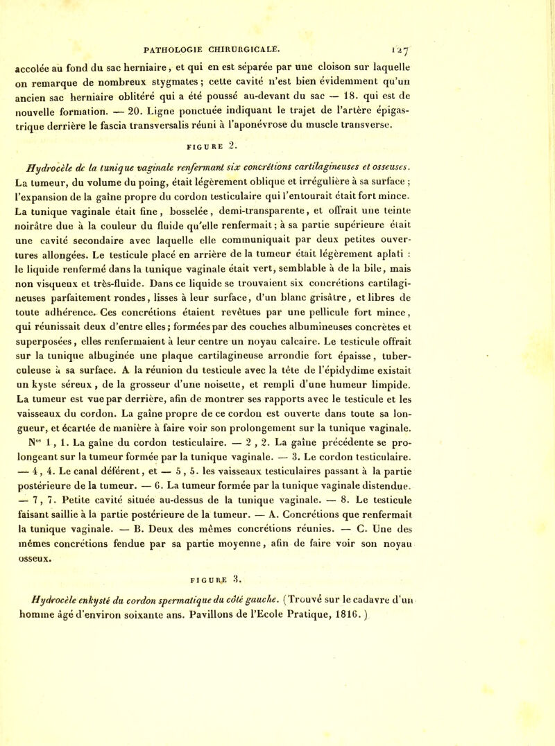 accolée au fond du sac herniaire, et qui en est séparée par une cloison sur laquelle on remarque de nombreux stygraales ; cette cavité n'est bien évidemment qu'un ancien sac herniaire oblitéré qui a été poussé au-devant du sac — 18. qui est de nouvelle formation. — 20. Ligne ponctuée indiquant le trajet de l'artère épigas- trique derrière le fascia iransversaiis réuni à l'aponévrose du muscle transverse. FIGU RE 2. Hydrocèle de la tunique vaginale renfermant six concrétions cartilagineuses et osseuses. La tumeur, du volume du poing, était légèrement oblique et irrégulière à sa surface ; l'expansion de la gaine propre du cordon lesliculaire qui l'entourait était fort mince. La tunique vaginale était fine, bosselée, demi-transparente, et offrait une teinte noirâtre due à la couleur du fluide qu'elle renfermait ; à sa partie supérieure était une cavité secondaire avec laquelle elle communiquait par deux petites ouver- tures allongées. Le testicule placé en arrière de la tumeur était légèrement aplati : le liquide renfermé dans la tunique vaginale était vert, semblable à de la bile, mais non visqueux et très-fluide. Dans ce liquide se trouvaient six concrétions cartilagi- neuses parfaitement rondes, lisses à leur surface, d'un blanc grisâtre, et libres de toute adhérence. Ces concrétions étaient revêtues par une pellicule fort mince, qui réunissait deux d'entre elles; formées par des couches albumineuses concrètes et superposées, elles renfermaient à leur centre un noyau calcaire. Le testicule offrait sur la tunique albuginée une plaque cartilagineuse arrondie fort épaisse, tuber- culeuse il sa surface. A la réunion du testicule avec la téte de l'épidydime existait un kyste séreux, de la grosseur d'une noisette, et rempli d'une humeur limpide. La tumeur est vue par derrière, afin de montrer ses rapports avec le testicule et les vaisseaux du cordon. La gaîne propre de ce cordon est ouverte dans toute sa lon- gueur, et écartée de manière à faire voir son prolongement sur la tunique vaginale. N 1 , 1. La gaine du cordon testiculaire. — 2 , 2. La gaîne précédente se pro- longeant sur la tumeur formée par la tunique vaginale. — 3. Le cordon testiculaire. — 4, 4. Le canal déférent, et — 5 , 5. les vaisseaux testiculaires passant à la partie postérieure de la tumeur. — 6. La tumeur formée par la tunique vaginale distendue. — 7,7. Petite cavité située au-dessus de la tunique vaginale. — 8. Le testicule faisant saillie à la partie postérieure de la tumeur. — A. Concrétions que renfermait la tunique vaginale. — B. Deux des mêmes concrétions réunies. — C. Une des mêmes concrétions fendue par sa partie moyenne, afin de faire voir son noyau osseux. FIGURE 3. Hydrocèle enkysté du cordon spermatique du côté gauche. ( Trouvé sur le cadavre d'un homme âgé d'environ soixante ans. Pavillons de l'Ecole Pratique, 1816. )