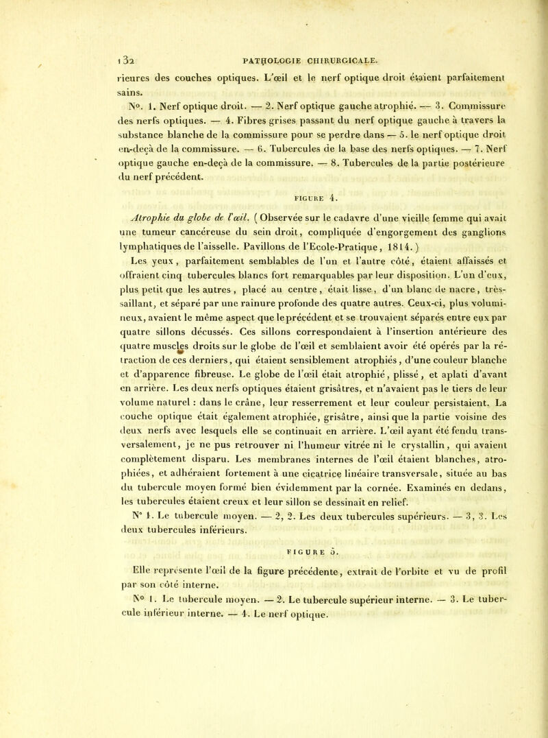 rieurcs des couches optiques. L'œil et le nerf optique droit é'.aient parfaiteraent sains. N». 1. Nerf optique droit. — 2. Nerf optique gauche atrophié. ~ 3. Coin;missure des nerfs optiques. — 4. Fibres grises passant du nerf optique gauche à travers la substance blanche de la commissure pour se perdre dans — 5. le nerf optique droit ea-deçà de la commissure. — 6. Tubercules de la base des nerfs optiques. — 7. Nerf optique gauche en-deçà de la commissure. — 8. Tubercules de la partie postérieure du nerf précédent. FIGURE 4. Atrophie du globe de Vceil. ( Observée sur le cadavre d'une vieille femme qui avait une tumeur cancéreuse du sein droit, compliquée d'engorgement des ganglions lymphatiques de l'aisselle. Pavillons de l'Ecole-Pratique, 1814.) Les yeux, parfaitement semblables de l'un et l'autre côté, étaient affaissés et offraient cinq tubercules blancs fort remarquables par leur disposition. L'un d'eux, plus petit que les autres , placé au centre , était lisse , d'un blanc de nacre , très- saillant, et séparé par une rainure profonde des quatre autres. Ceux-ci, plus volumi- neux, avaient le même aspect que le précédent et se trouvaient séparés entre eux par quatre sillons déçusses. Ces sillons correspondaient à l'insertion antérieure des quatre muscles droits sur le globe de l'œil et semblaient avoir été opérés par la ré- traction de ces derniers, qui étaient sensiblement atrophiés, d'une couleur blanche et d'apparence fibreuse. Le globe de l'œil était atrophié, plissé, et aplati d'avant en arrière. Les deux nerfs optiques étaient grisâtres, et n'avaient pas le tiers de leur volume naturel : dans le crâne, leur resserrement et leur couleur persistaient. La couche optique était également atrophiée, grisâtre, ainsi que la partie voisine des deux nerfs avec lesquels elle se continuait en arrière. L'œil ayant été fendu trans- versalement, je ne pus retrouver ni l'humeur vitrée ni le crystallin, qui avaient complètement disparu. Les membranes internes de l'œil étaient blanches, atro- phiées, et adhéraient fortement à une çiçatriçç linéaire transversale, située au bas du tubercule moyen formé bien évidemment par la cornée. Examinés en dedans, les tubercules étaient creux et leur sillon se dessinait en relief. N° t. Le tubercule moyen. — 2, 2. Les deux tubercules supérieurs. — 3, 3. Los deux tubercules inférieurs. FIGURE Ô. Elle représente l'œil de la figure précédente, extrait de l'orbite et vu de profil par son côté interne. N° I. Le tubercule moyen. —2. Le tubercule supérieur interne. — 3. Le tuber- cule inférieur interne. — 4. Le nerf optique.