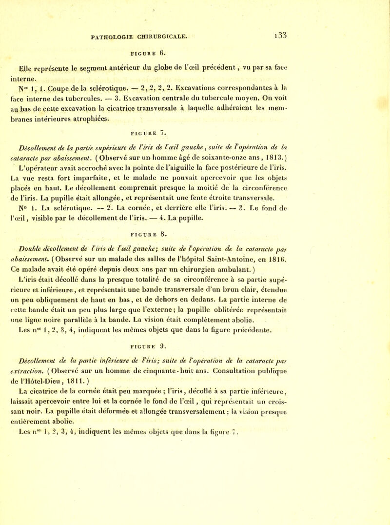 FIGURE 6. EUe représente le segment antérieur du globe de l'œil précédent, vu par sa face interne. N' 1,1. Coupe de la sclérotique. — 2, 2, 2, 2. Excavations correspondantes à la face interne des tubercules. — 3. Excavation centrale du tubercule moyen. On voit au bas de cette excavation la cicatrice transversale à laquelle adhéraient les mem- branes intérieures atrophiées. FIGL'RE 7. Décollement de la partie supérieure de l'iris de l'œil gauche, suite de l'opération de la cataracte par abaissement. ( Observé sur un homme âgé de soixante-onze ans , 1813.) L'opérateur avait accroché avec la pointe de l'aiguille la face postérieure de l'iris. La vue resta fort imparfaite, et le malade ne pouvait apercevoir que les objets placés en haut. Le décollement comprenait presque la moitié de la circonférence de l'iris. La pupille était allongée, et représentait une fente étroite transversale. N° 1. La sclérotique. — 2. La cornée, et derrière elle l'iris. ~ 3. Le fond de l'œil, visible par le décollement de l'iris. — 4. La pupille. FIGURE 8. Double décollement de l'iris de l'œil gauche; suite de l'opération de la cataracte par abaissement. (Observé sur un malade des salles de l'hôpital Saint-Â.ntoine, en 1816. Ce malade avait été opéré depuis deux ans par un chirurgien ambulant. ) L'iris était décollé dans la presque totalité de sa circonférence à sa partie supé- rieure et inférieure, et représentait une bande transversale d'un brun clair, étendue un peu obliquement de haut en bas, et de dehors en dedans. La partie interne de cette bande était un peu plus large que l'externe; la pupille oblitérée représentait ime ligne noire parallèle à la bande. La vision était complètement abolie. Les n°' 1,2,3, 4, indiquent les mêmes objets que dans la figure précédente. FIGURE 9. Décollement de la partie inférieure de l'iris; suite de l'opération de la cataracte par extraction. (Observé sur un homme de cinquante-huit ans. Consultation publique de l'Hôtel-Dieu, 1811.) La cicatrice de la cornée était peu marquée ; l'iris, décollé à sa partie inférieure, laissait apercevoir entre lui et la cornée le fond de l'œil, qui représentait un crois- sant noir. La pupille était déformée et allongée transversalement ; la vision presque entièrement abolie. Les n' 1, 2, 3, 4, indiquent les mêmes objets que dans la figure T.