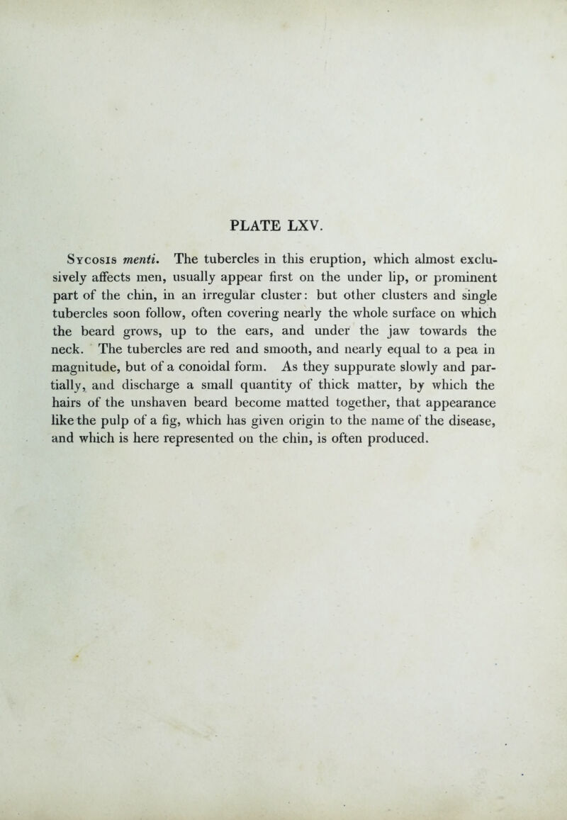 Sycosis menti. The tubercles in this eruption, which almost exclu- sively affects men, usually appear first on the under lip, or prominent part of the chin, in an irregular cluster: but other clusters and single tubercles soon follow, often covering nearly the whole surface on which the beard grows, up to the ears, and under the jaw towards the neck. The tubercles are red and smooth, and nearly equal to a pea in magnitude, but of a conoidal form. As they suppurate slowly and par- tially, and discharge a small quantity of thick matter, by which the hairs of the unshaven beard become matted together, that appearance like the pulp of a fig, which has given origin to the name of the disease, and which is here represented on the chin, is often produced.